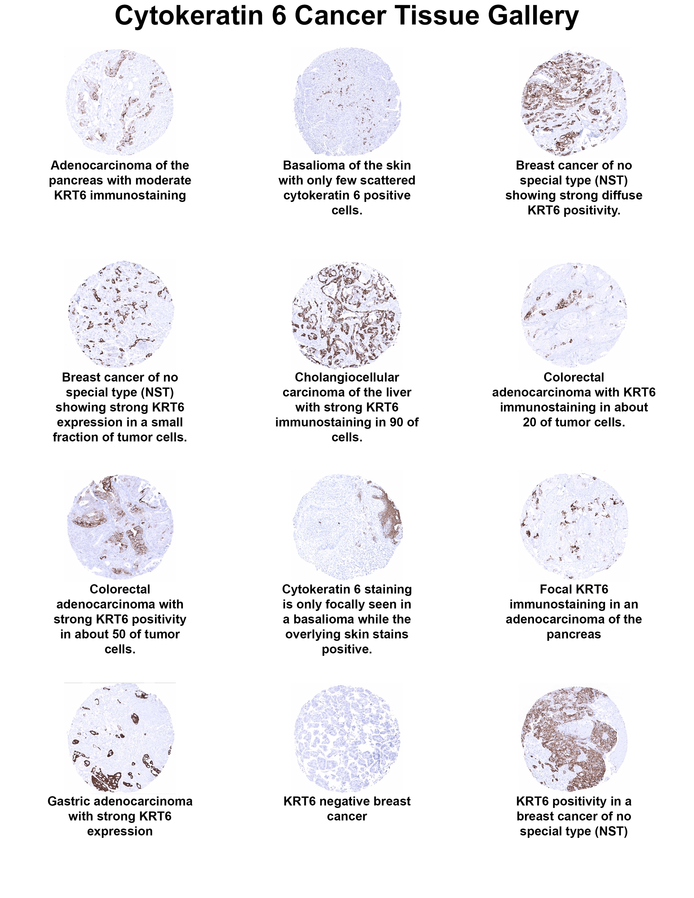 Cytokeratin 6 Antibody (MSVA-606R) Cytokeratin 6 Antibody (MSVA-606R) Cytokeratin 6 Cancer Tissue Gallery