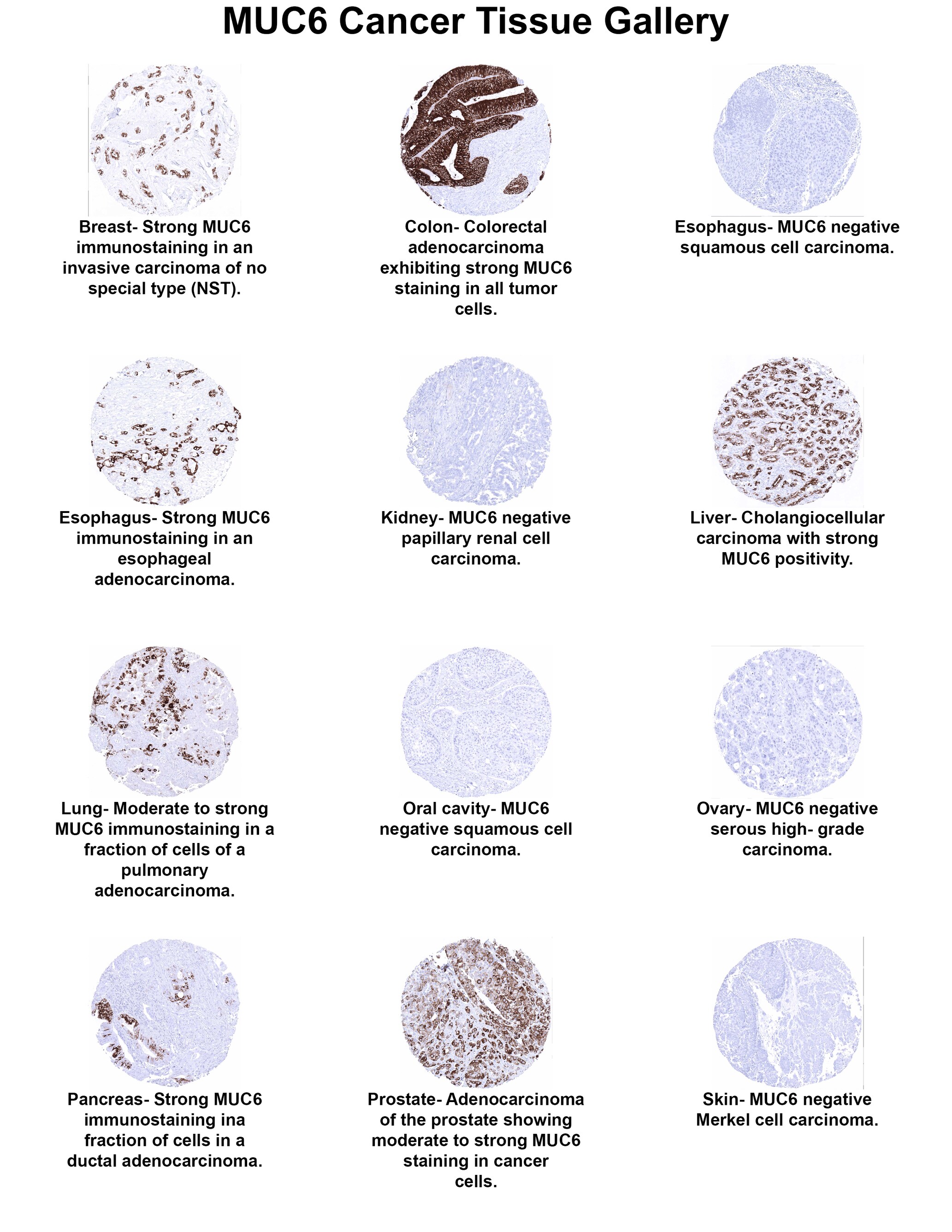 MUC6 Antibody (MSVA-806R) MUC6 Antibody (MSVA-806R) MUC6 Cancer Tissue Gallery