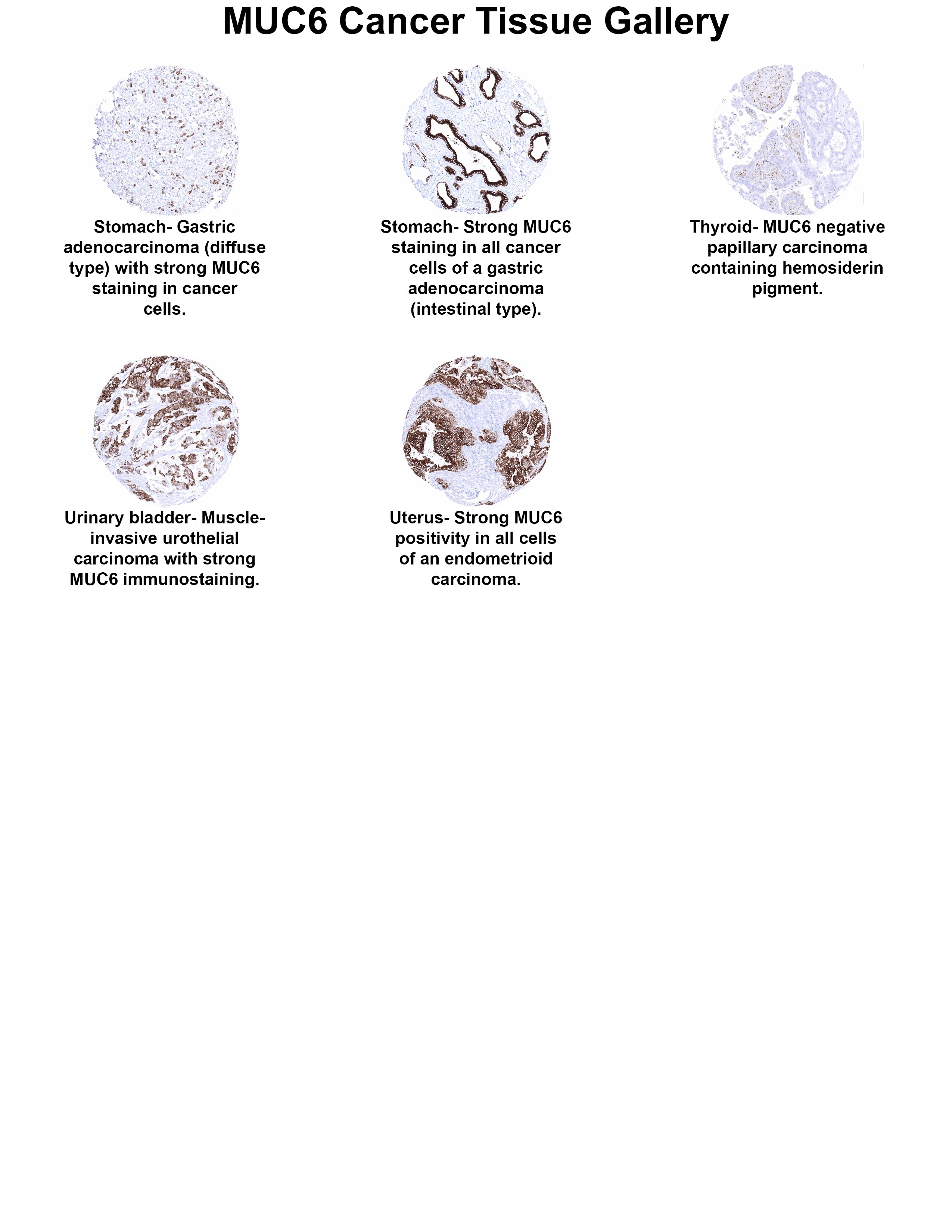 MUC6 Antibody (MSVA-806R) MUC6 Antibody (MSVA-806R) MUC6 Cancer Tissue Gallery