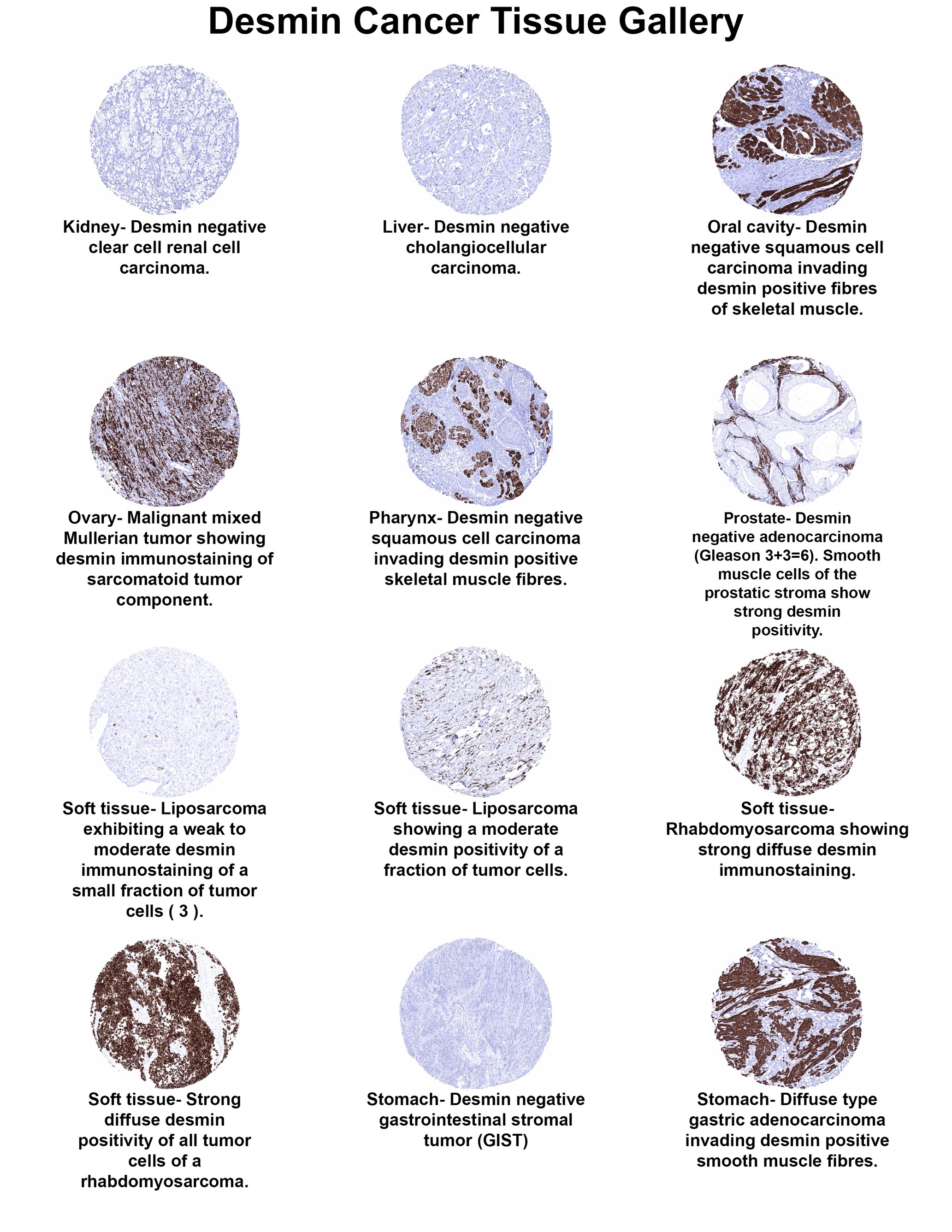 Desmin Antibody (MSVA-651M) Desmin Antibody (MSVA-651M) Desmin Cancer Tissue Gallery
