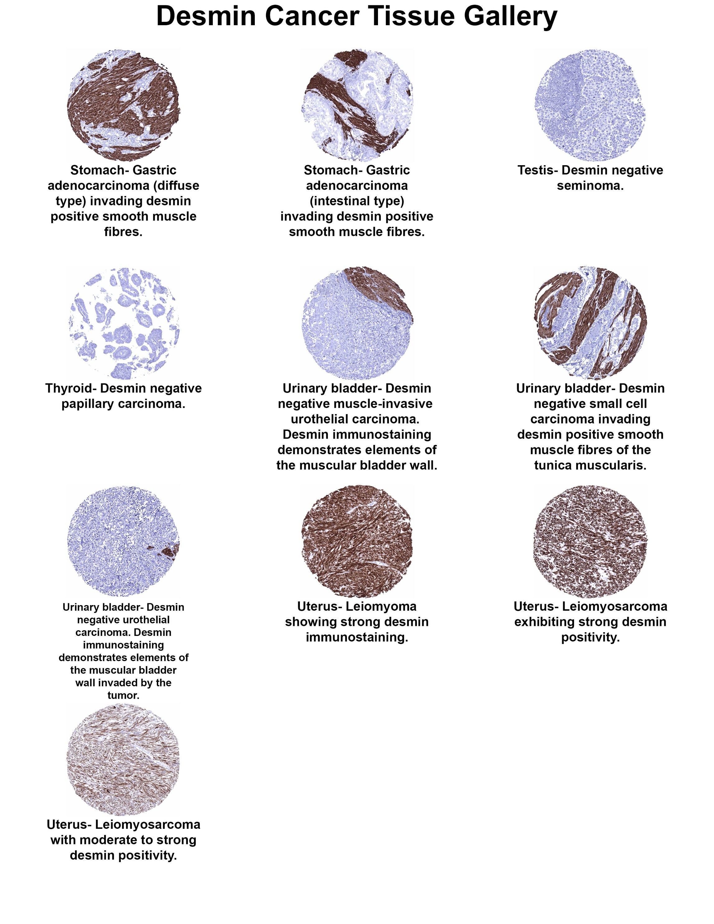 Desmin Antibody (MSVA-651M) Desmin Antibody (MSVA-651M) Desmin Cancer Tissue Gallery