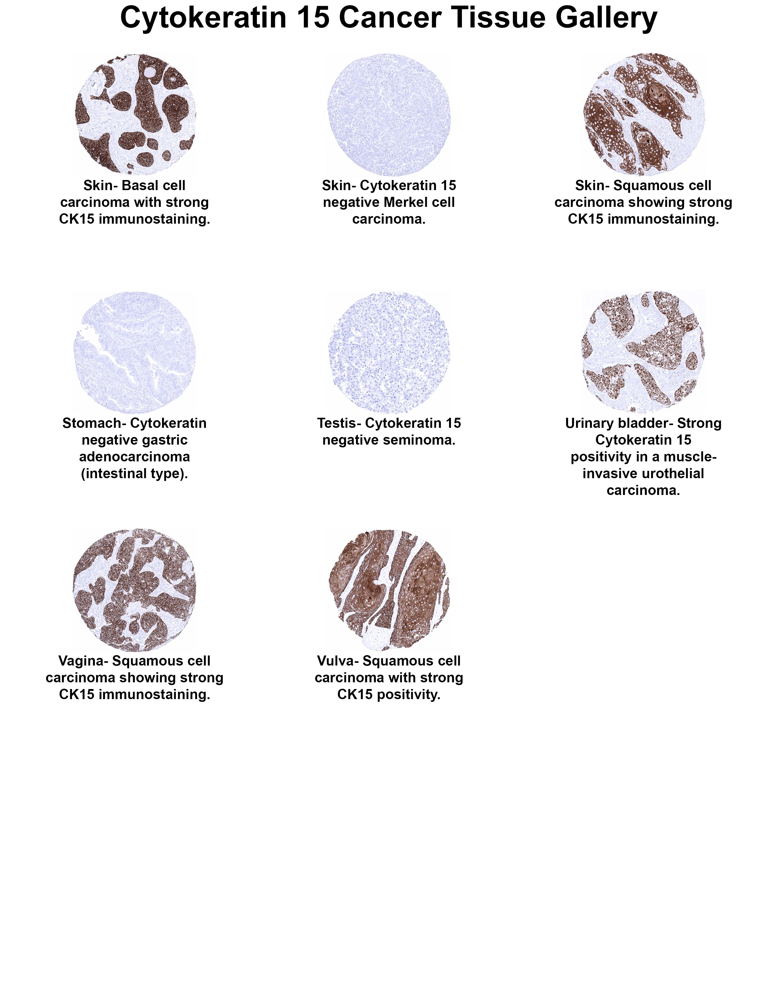 Cytokeratin 15 Antibody (MSVA-615M) Cytokeratin 15 Antibody (MSVA-615M) Cytokeratin 15 Cancer Tissue Gallery