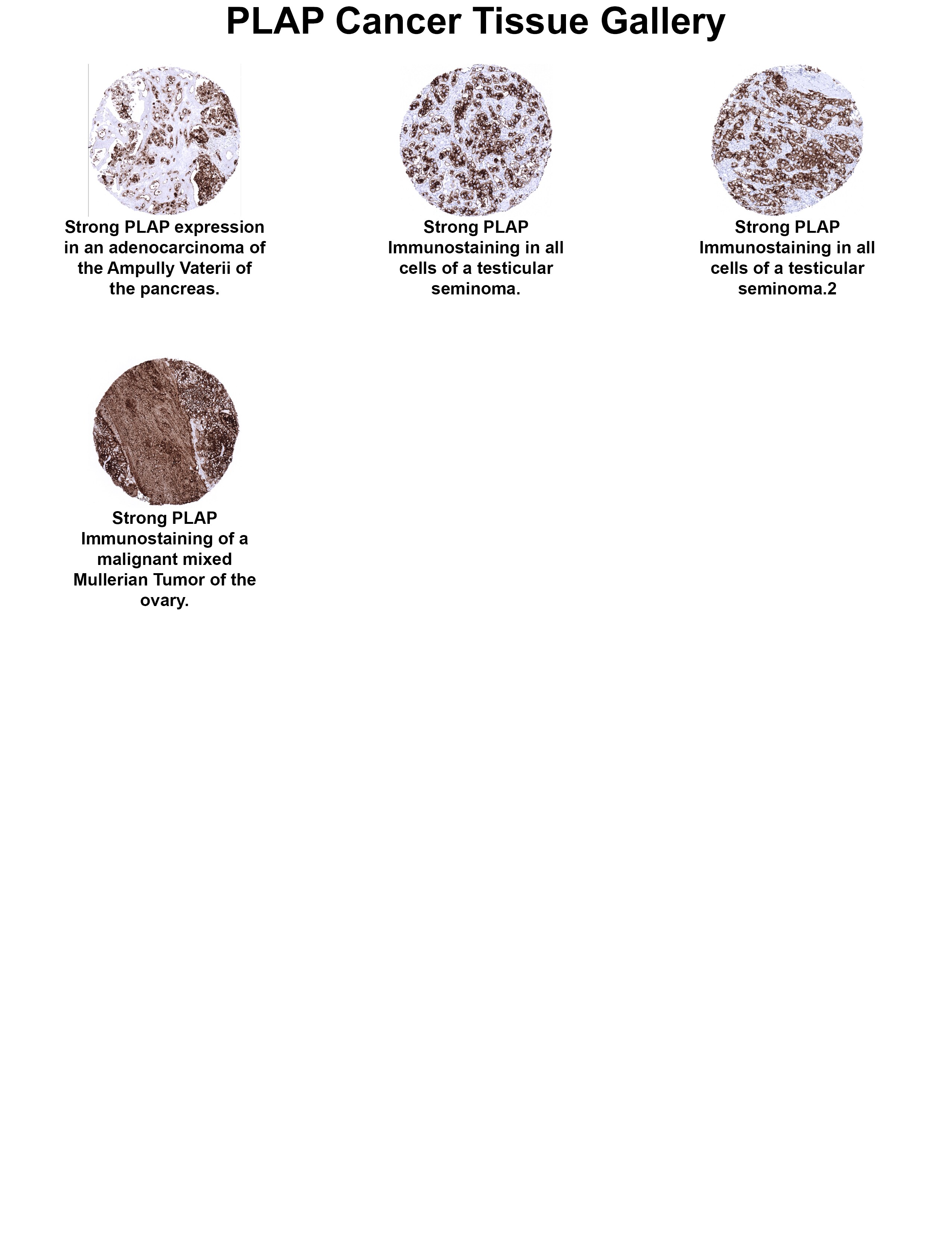 PLAP Antibody (MSVA-350R) PLAP Antibody (MSVA-350R) PLAP Cancer Tissue Gallery