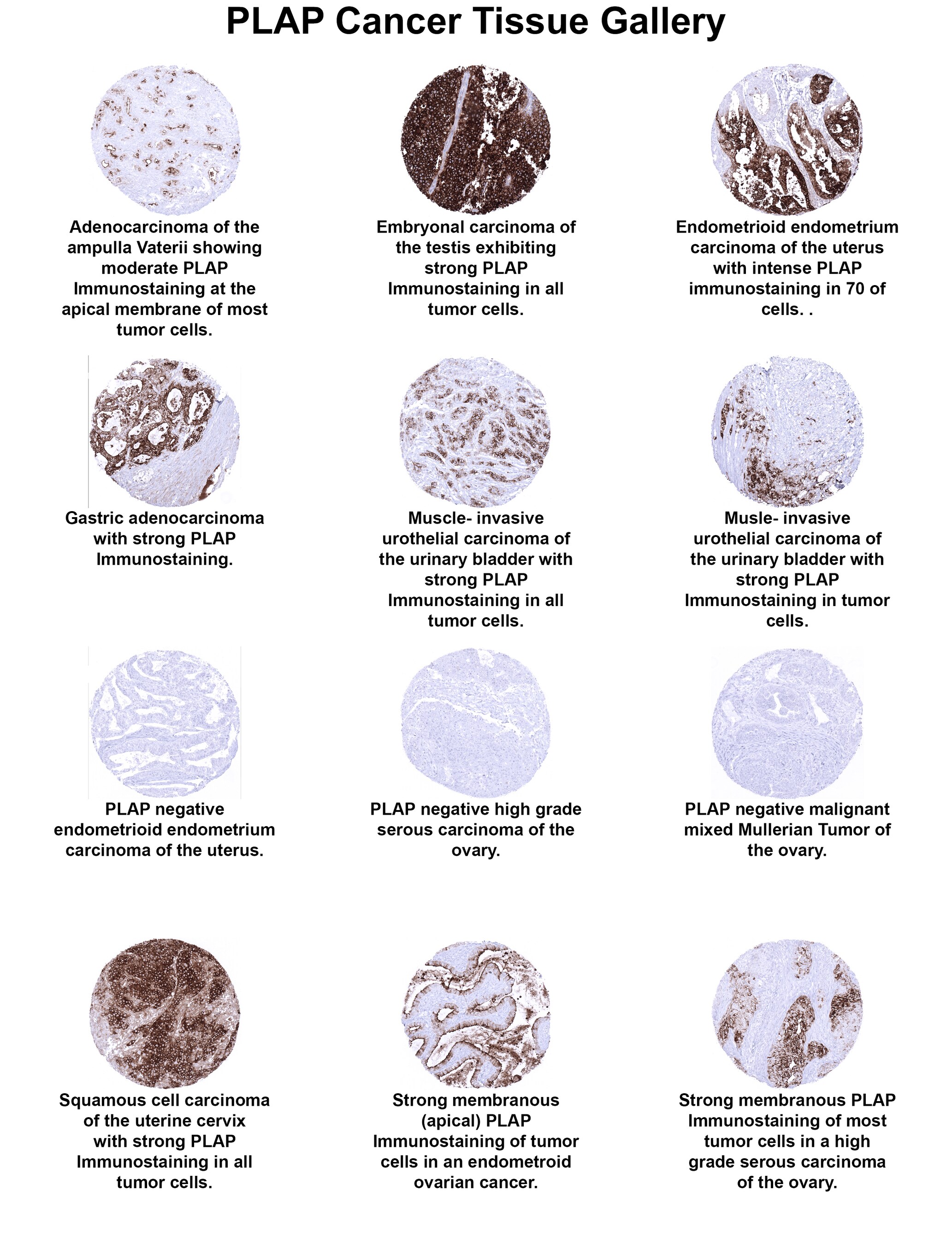 PLAP Antibody (MSVA-350R) PLAP Antibody (MSVA-350R) PLAP Cancer Tissue Gallery