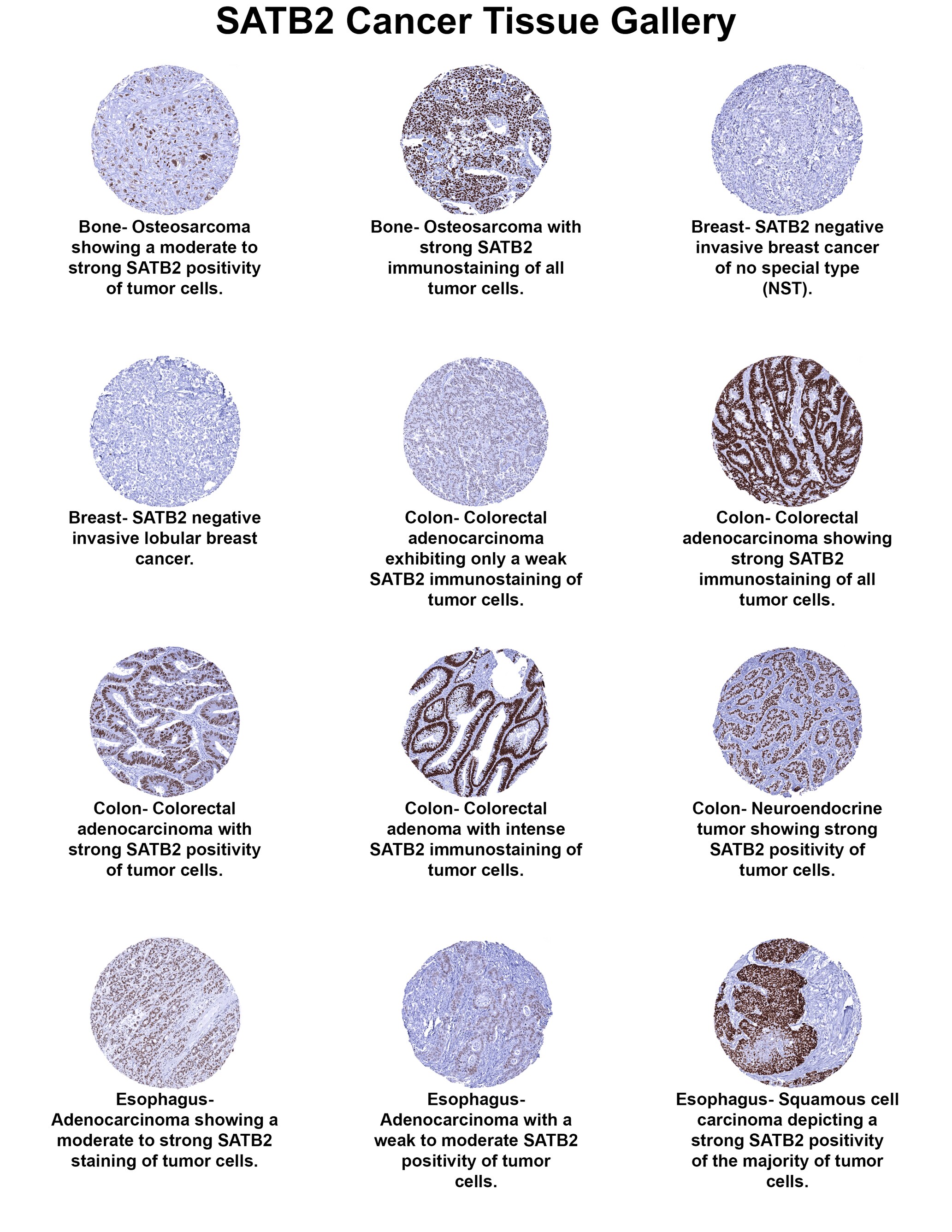 SATB2 Antibody (MSVA-702R) SATB2 Antibody (MSVA-702R) SATB2 Cancer Tissue Gallery