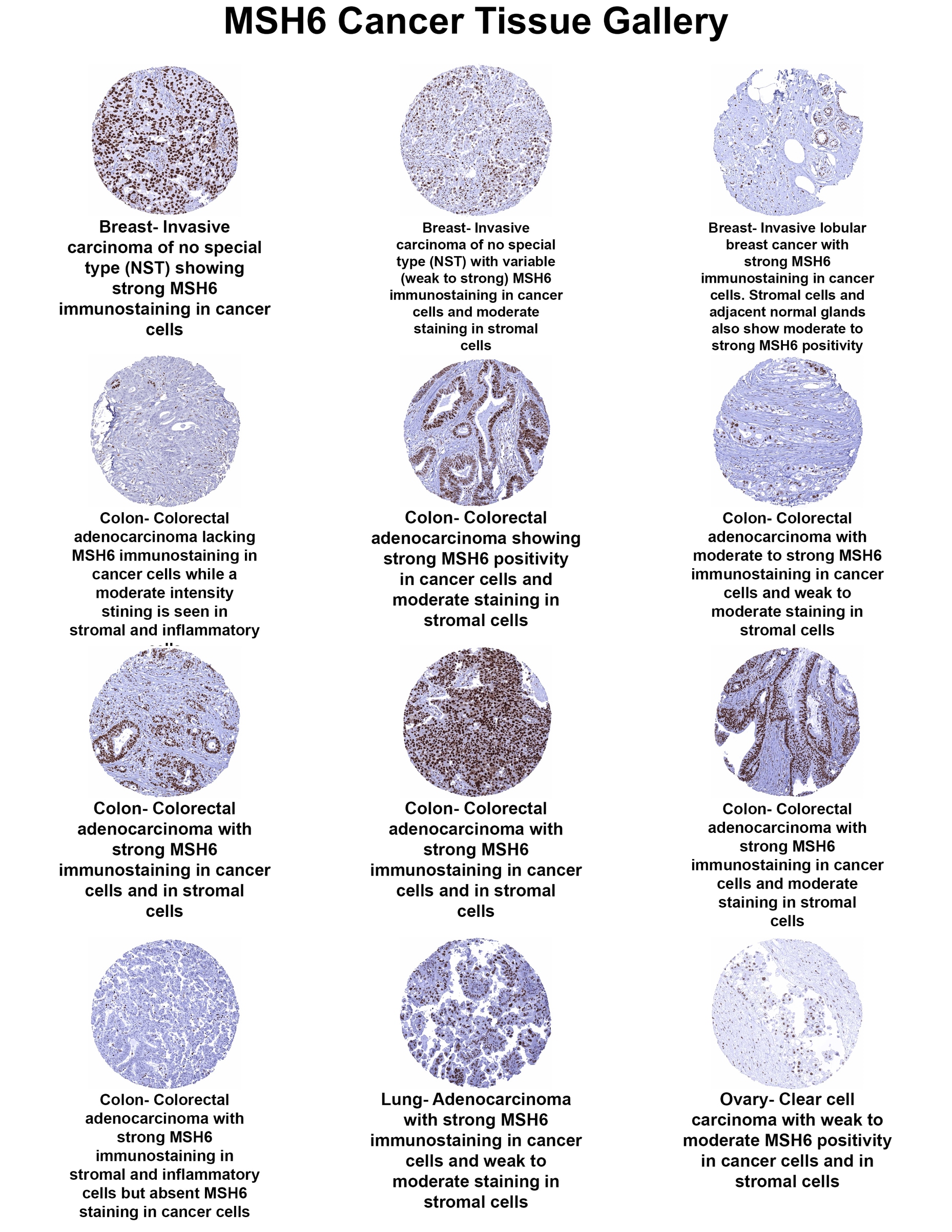 MSH6 Antibody (MSVA-906R) MSH6 Antibody (MSVA-906R) MSH6 Cancer Tissue Gallery