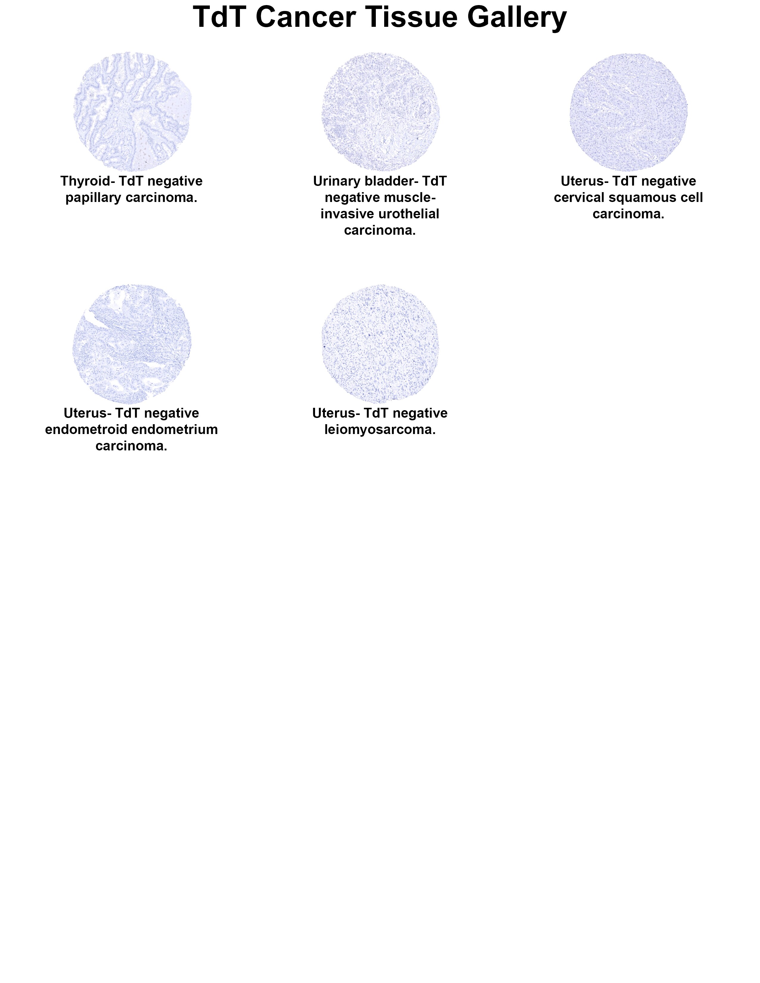 TdT Antibody (MSVA-453R) TdT Antibody (MSVA-453R) TdT Cancer Tissue Gallery