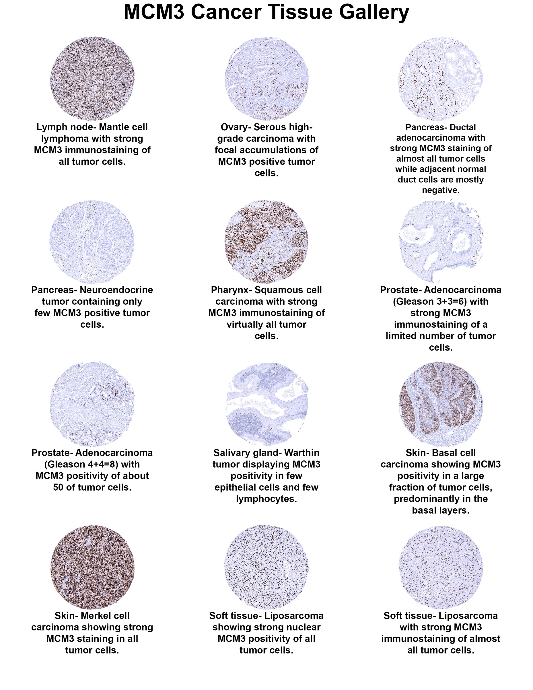 MCM3 Antibody (MSVA-503M) MCM3 Antibody (MSVA-503M) MCM3 Cancer Tissue Gallery