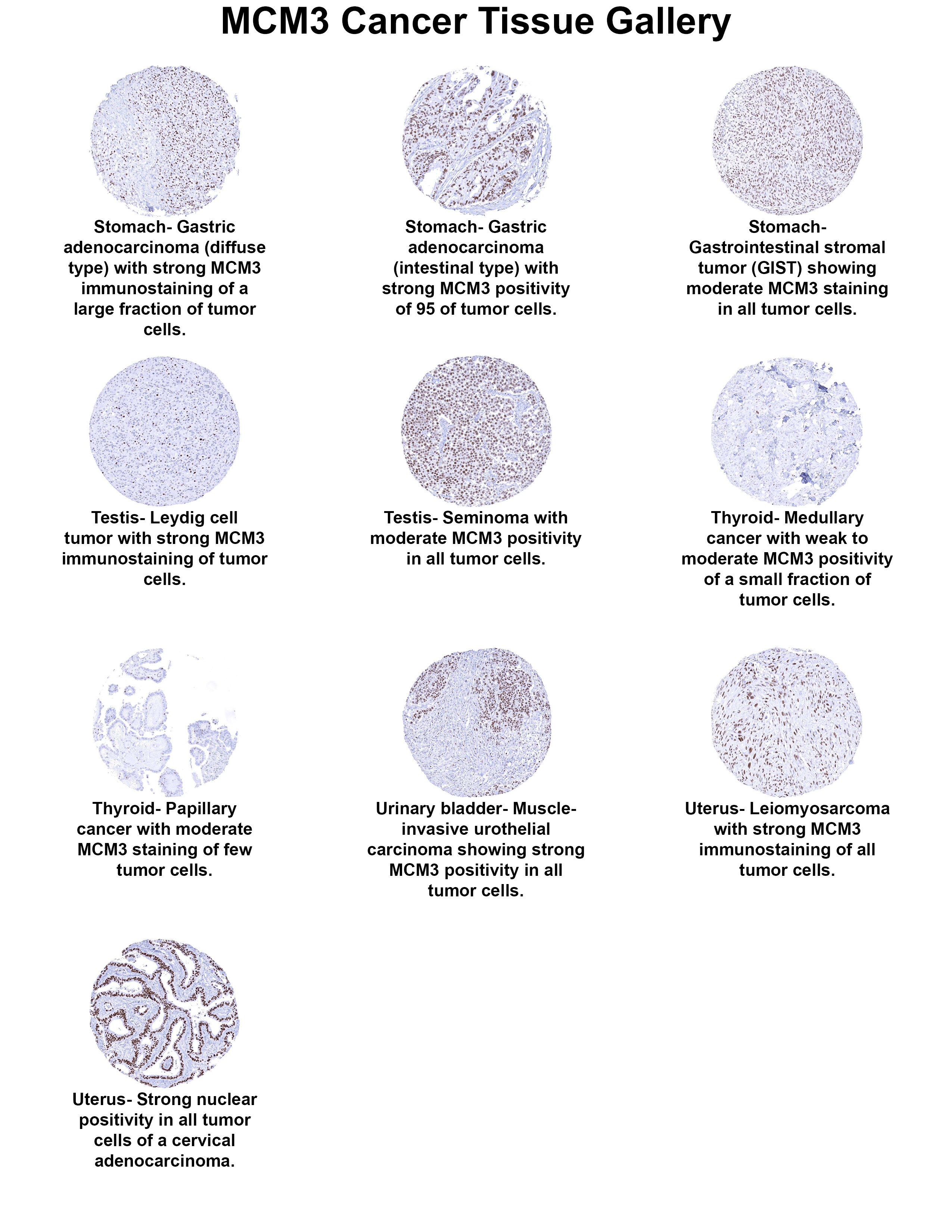 MCM3 Antibody (MSVA-503M) MCM3 Antibody (MSVA-503M) MCM3 Cancer Tissue Gallery