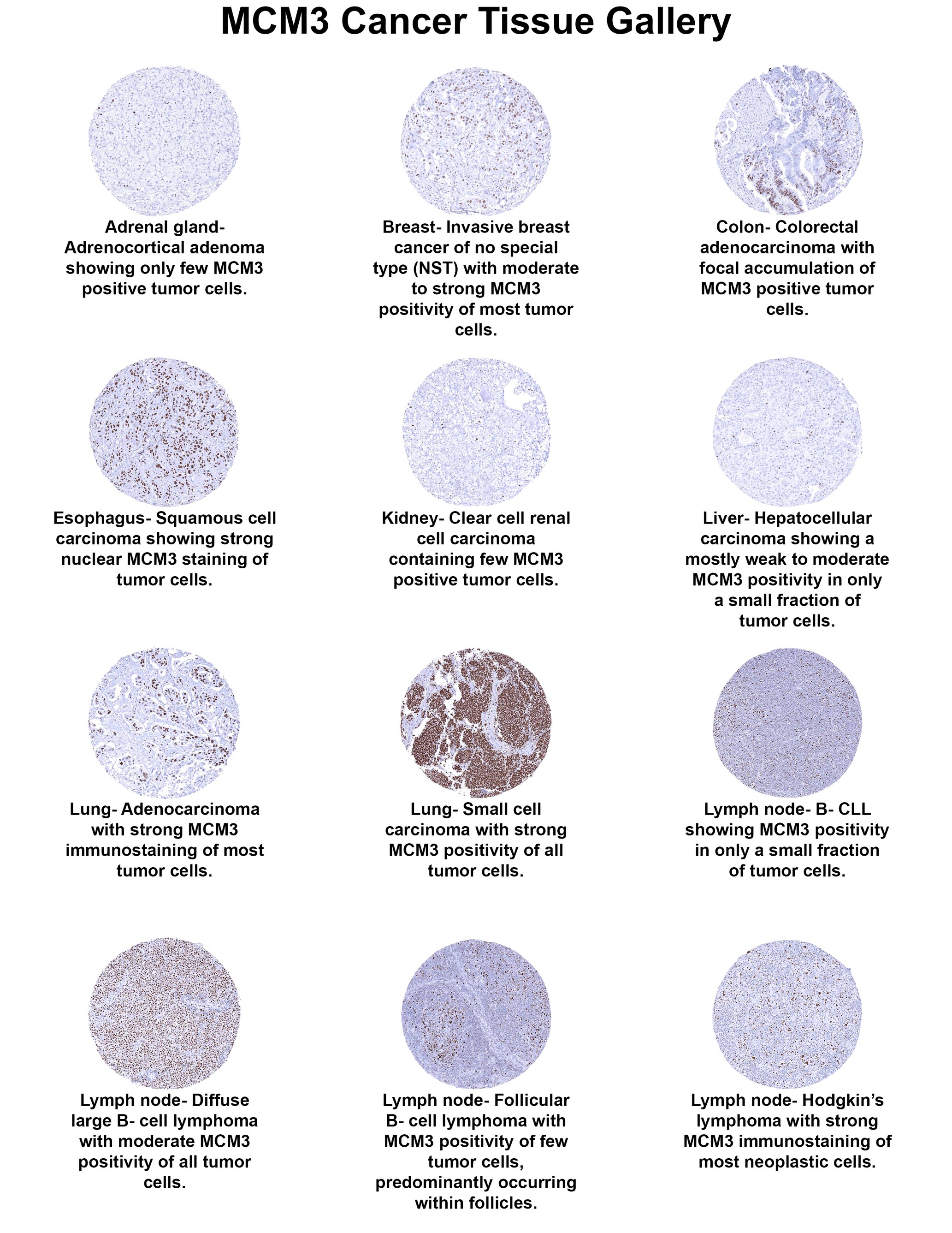 MCM3 Antibody (MSVA-503M) MCM3 Antibody (MSVA-503M) MCM3 Cancer Tissue Gallery