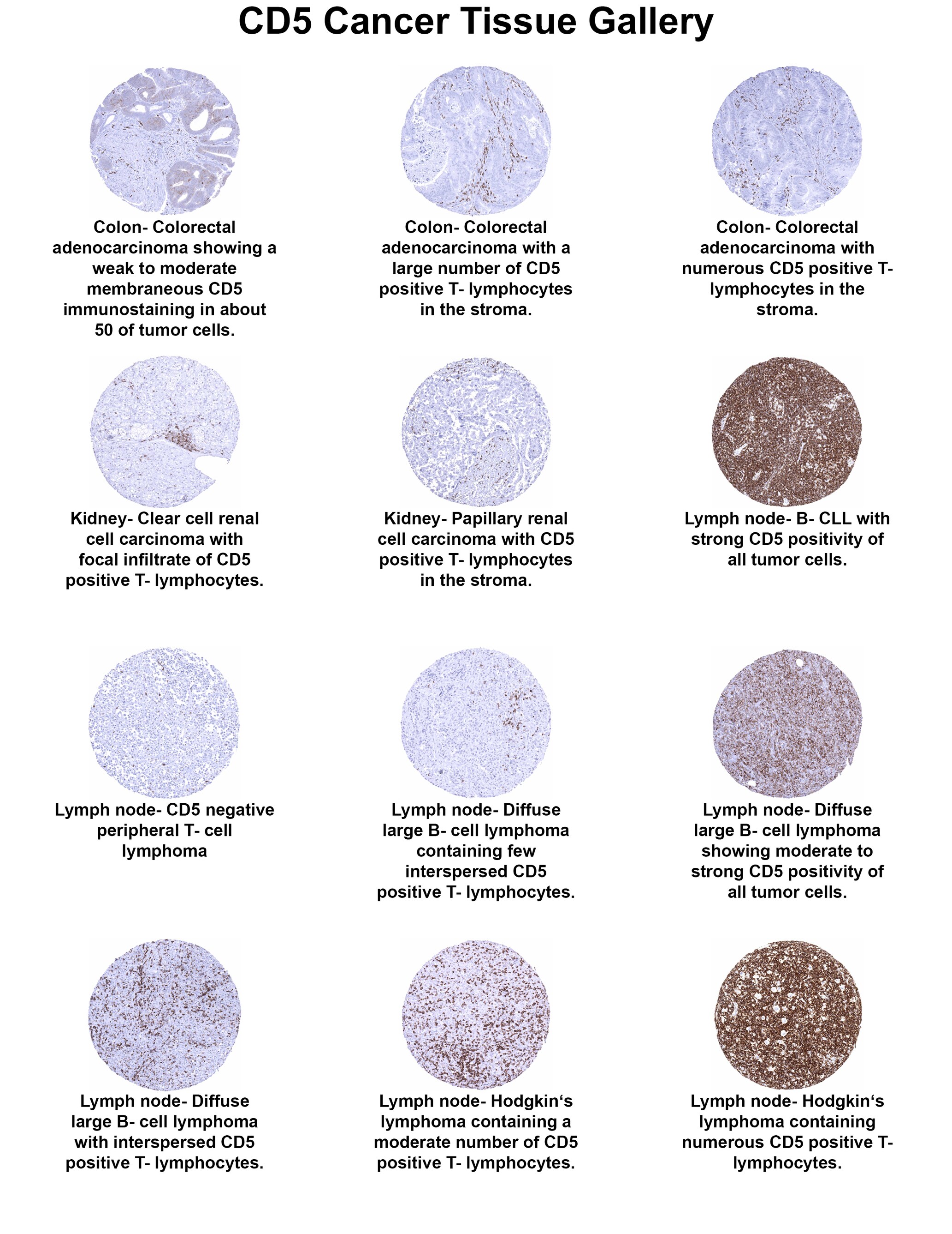 CD5 Antibody (MSVA-005R) CD5 Antibody (MSVA-005R) CD5 Cancer Tissue Gallery