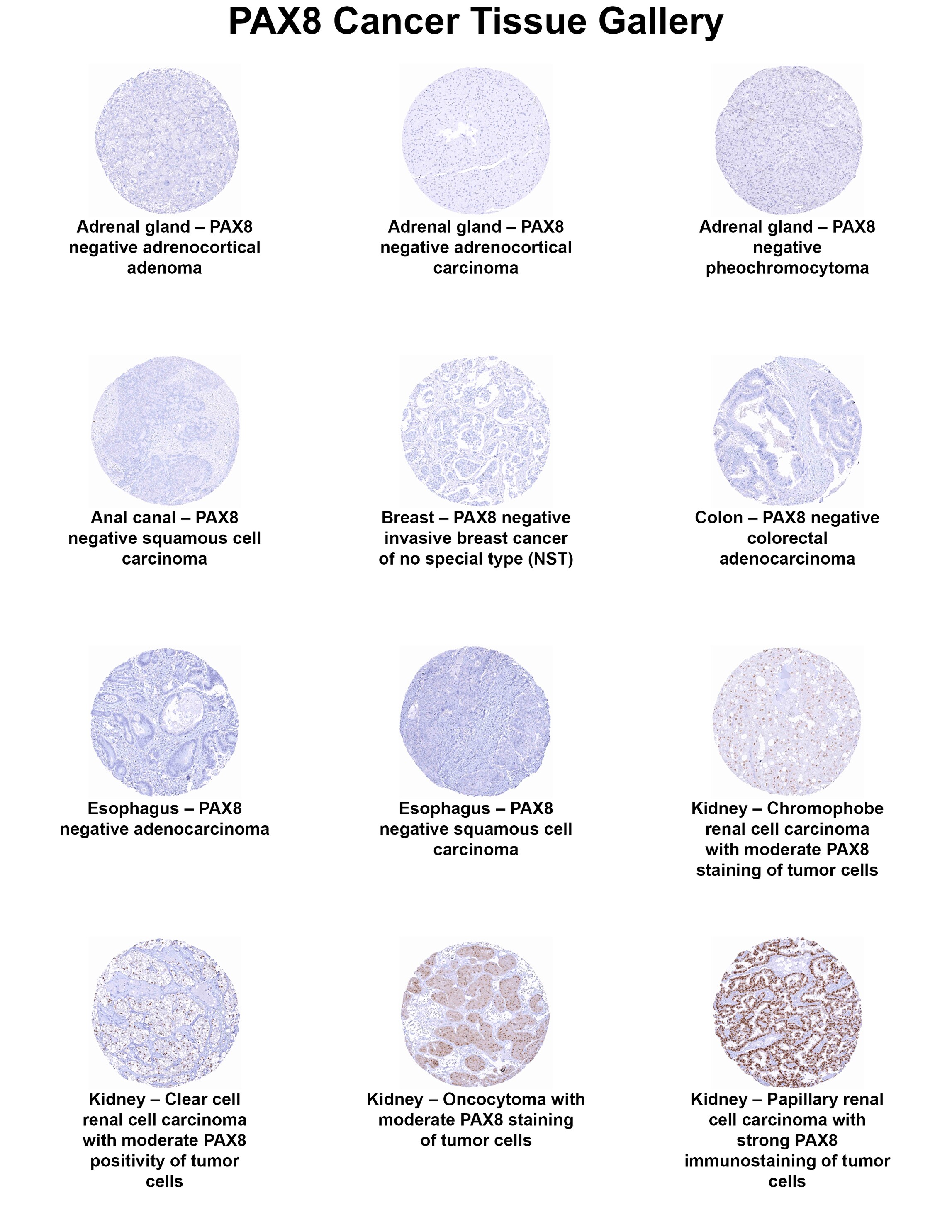 PAX8 Antibody (MSVA-708R) PAX8 Antibody (MSVA-708R) PAX8 Cancer Tissue Gallery