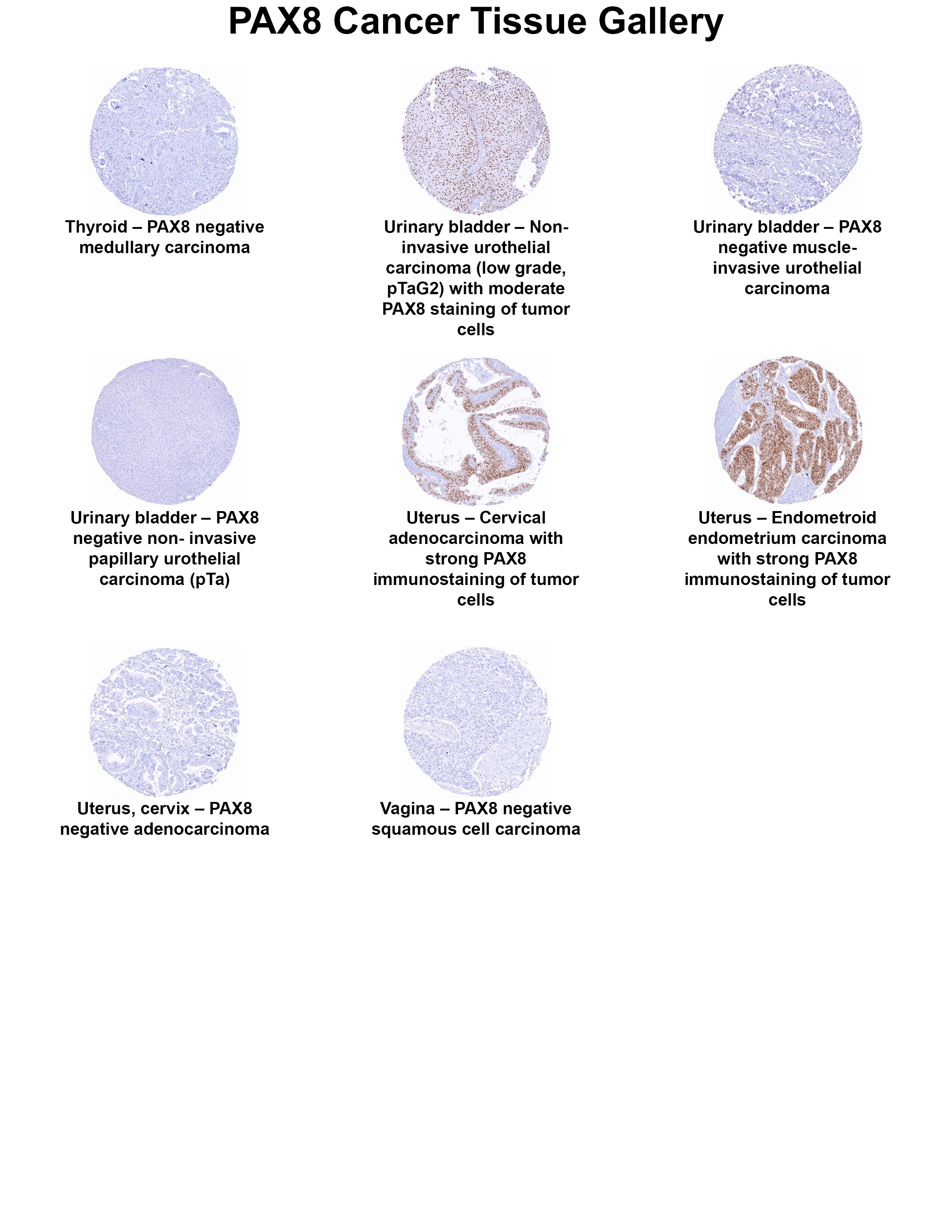 PAX8 Antibody (MSVA-708R) PAX8 Antibody (MSVA-708R) PAX8 Cancer Tissue Gallery
