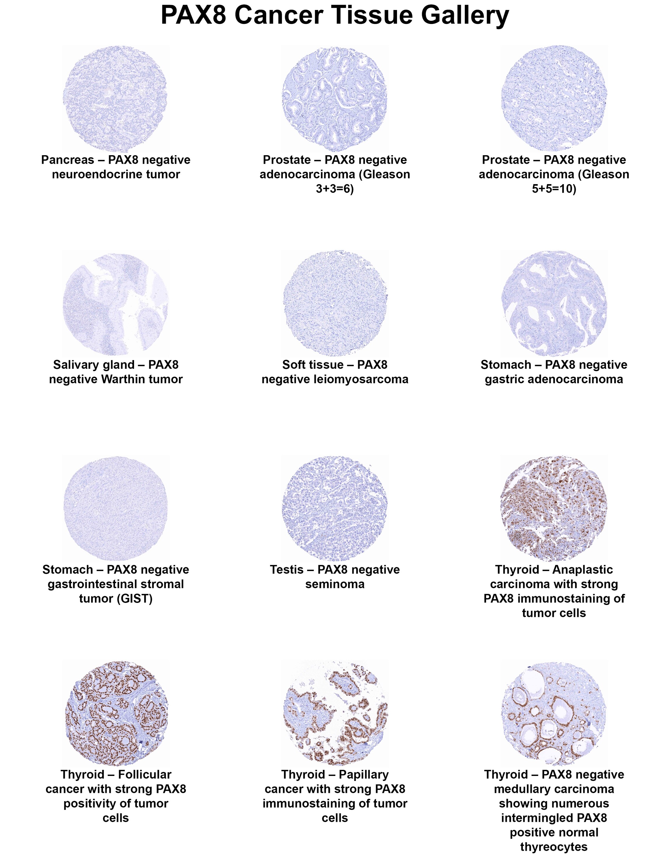 PAX8 Antibody (MSVA-708R) PAX8 Antibody (MSVA-708R) PAX8 Cancer Tissue Gallery