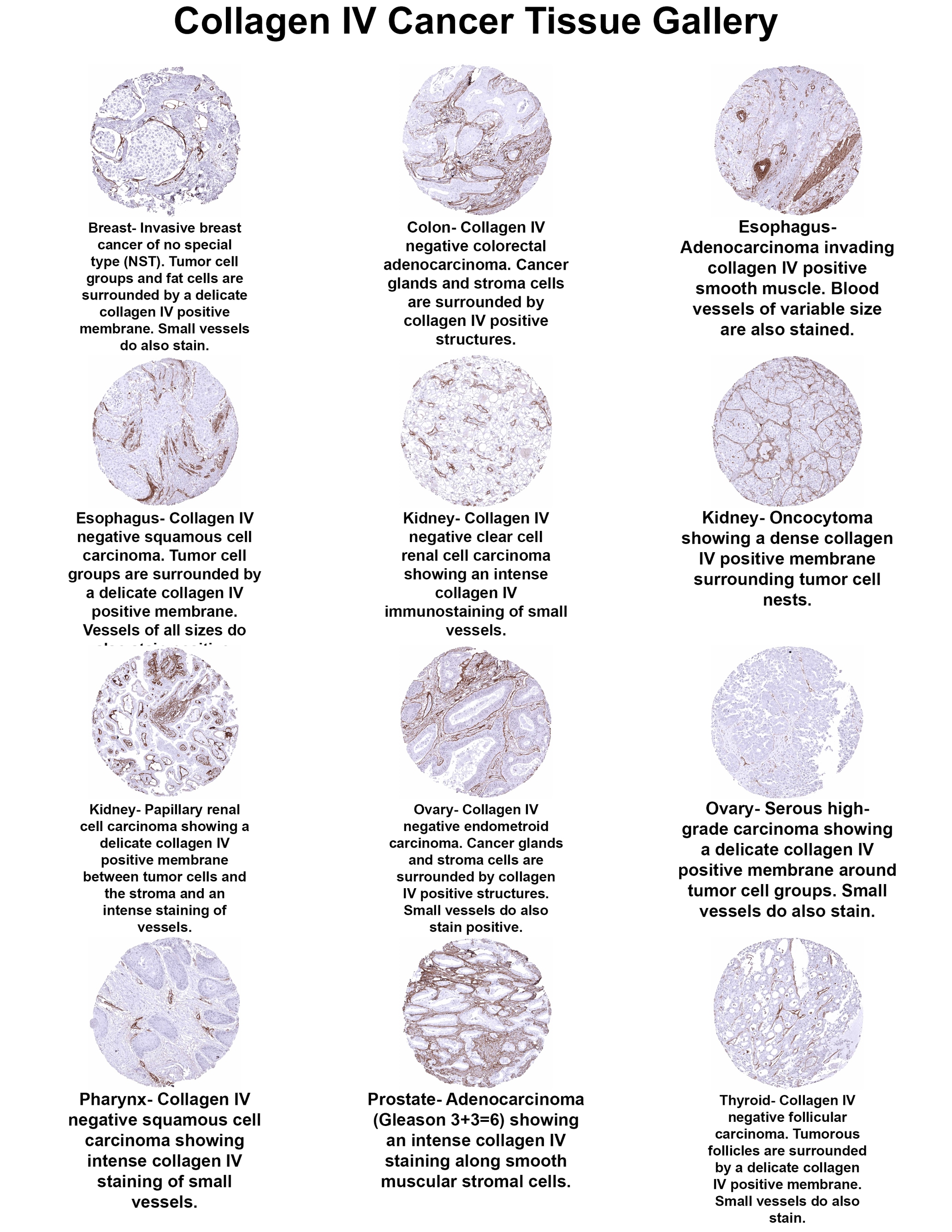 Collagen IV Antibody (MSVA-704R) Collagen IV Antibody (MSVA-704R) Collagen IV Cancer Tissue Gallery