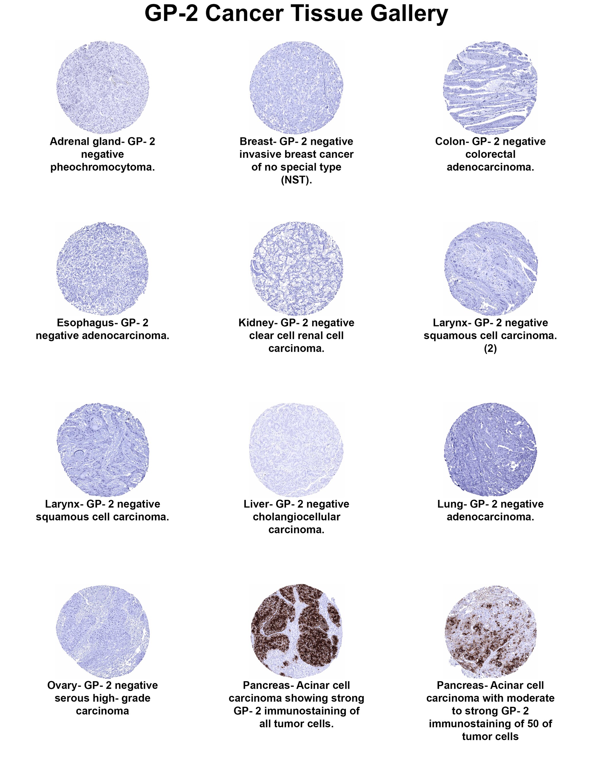 GP2 Antibody (MSVA-475M) GP2 Antibody (MSVA-475M) GP2 Cancer Tissue Gallery