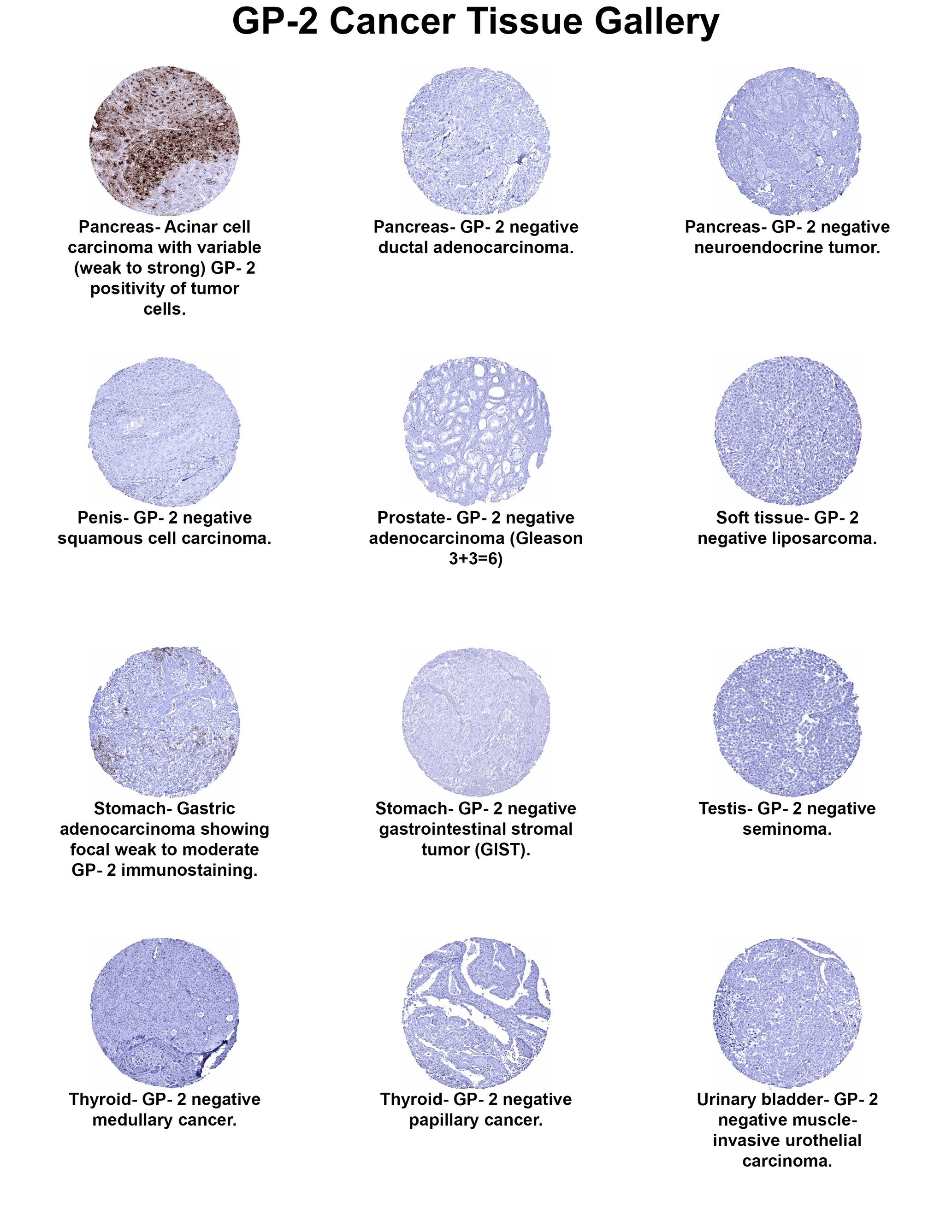 GP2 Antibody (MSVA-475M) GP2 Antibody (MSVA-475M) GP2 Cancer Tissue Gallery
