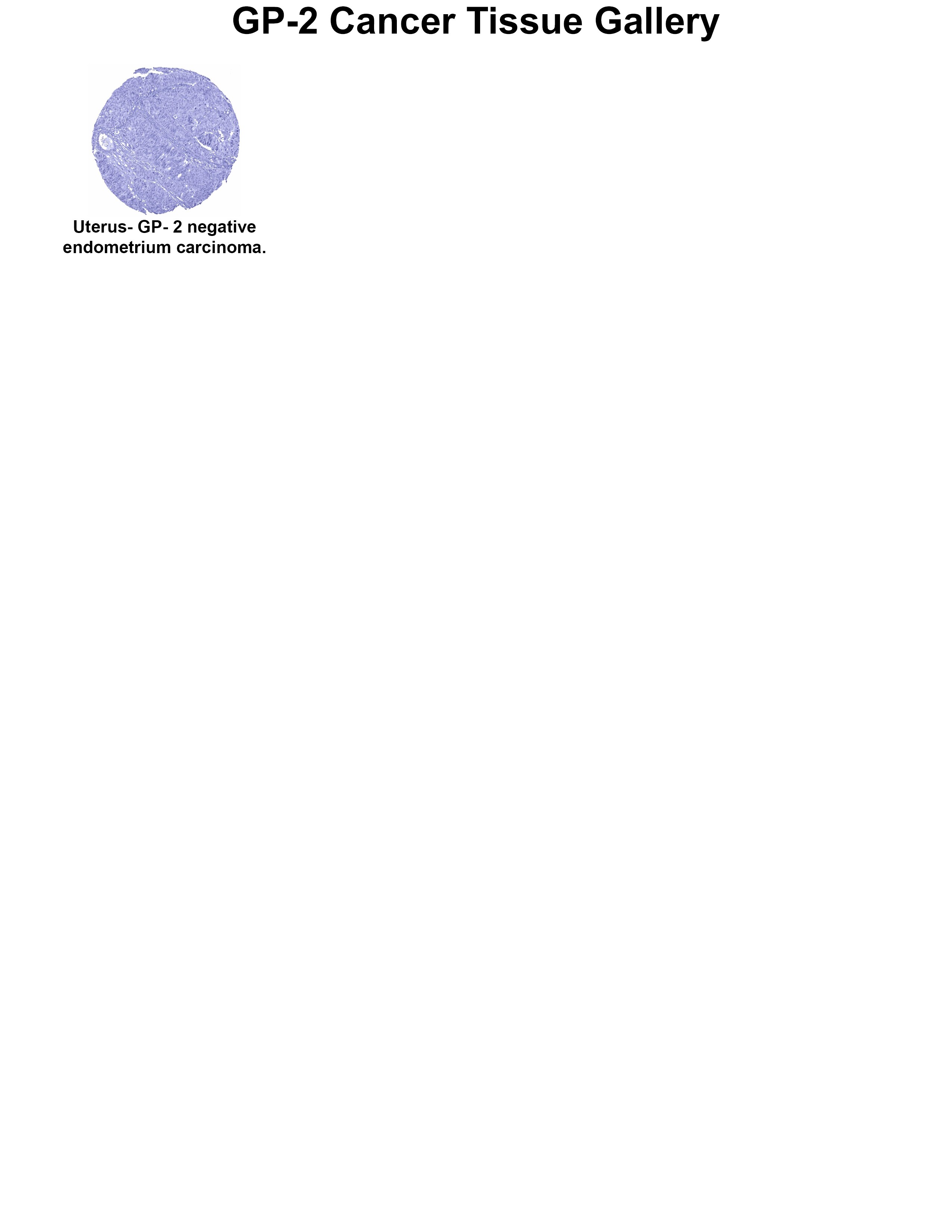GP2 Antibody (MSVA-475M) GP2 Antibody (MSVA-475M) GP2 Cancer Tissue Gallery