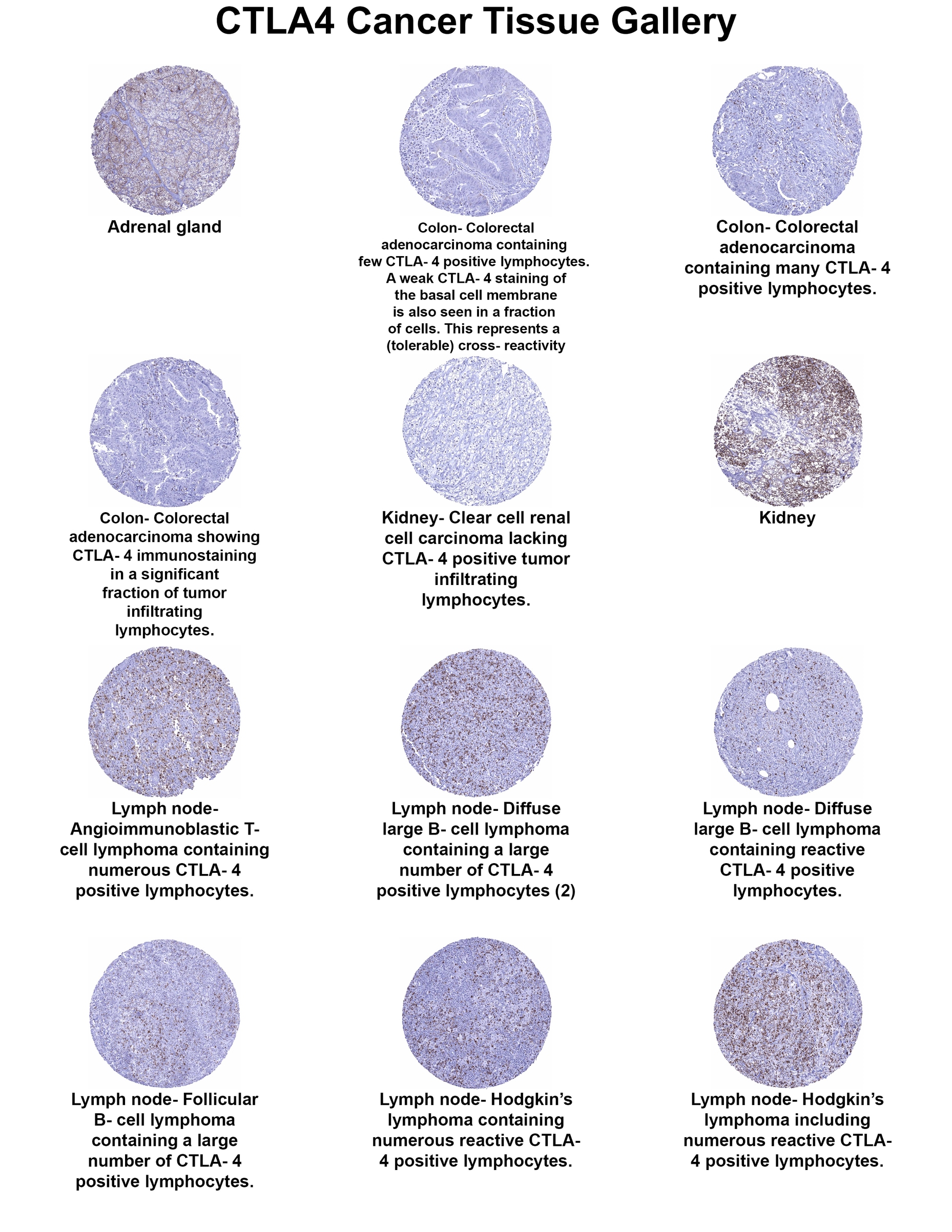 CTLA-4 Antibody (MSVA-152R) CTLA-4 Antibody (MSVA-152R) CTLA-4 Cancer Tissue Gallery