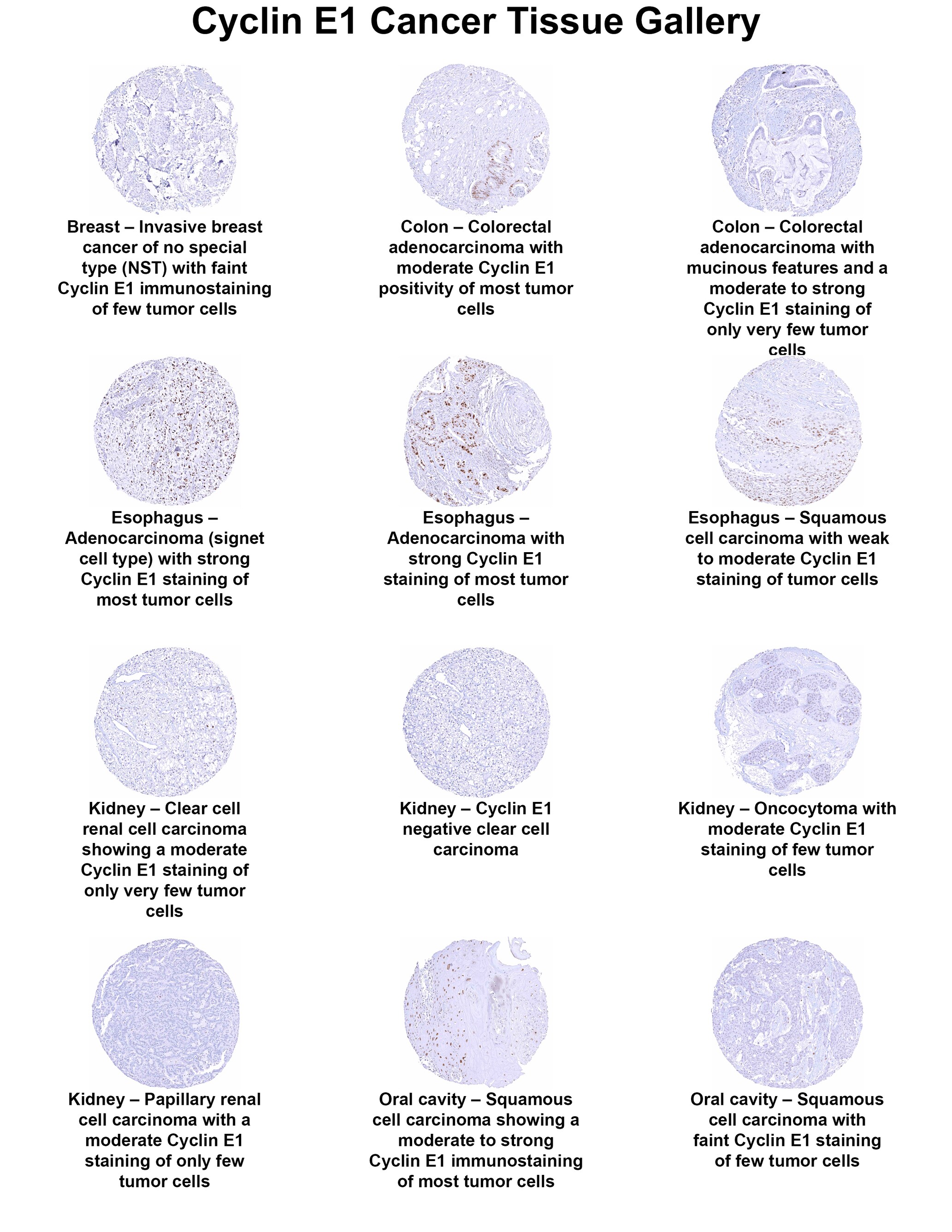 Cyclin E1 Antibody (MSVA-898R) Cyclin E1 Antibody (MSVA-898R) Cyclin E1 Cancer Tissue Gallery