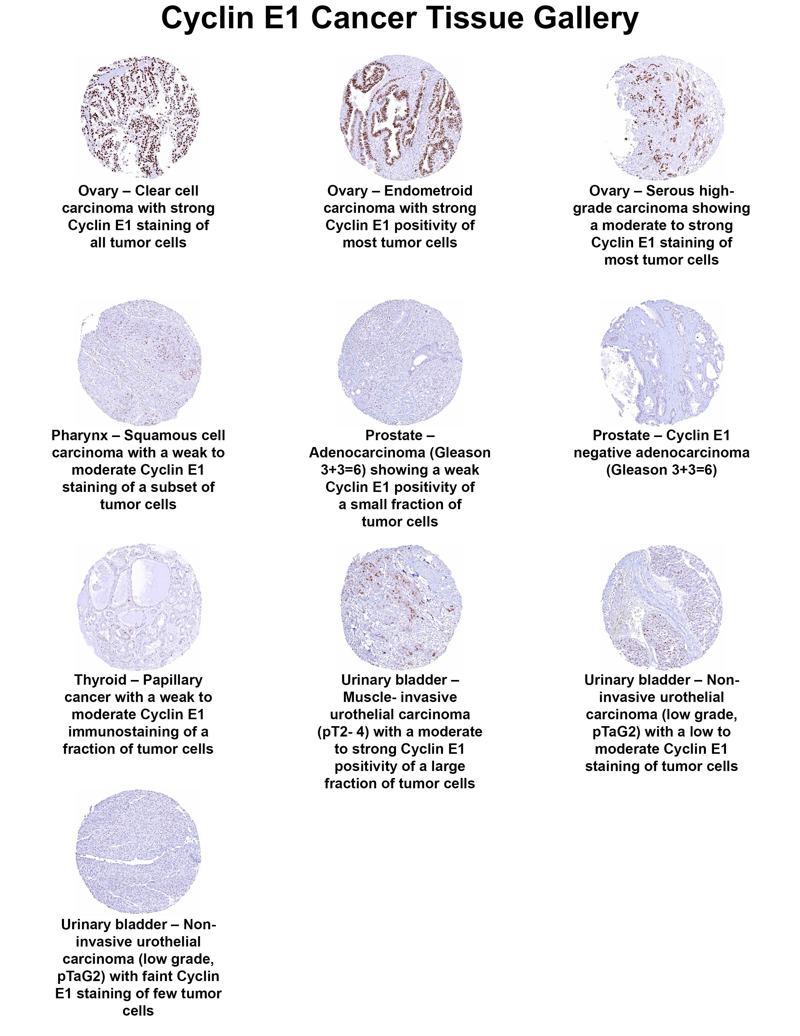 Cyclin E1 Antibody (MSVA-898R) Cyclin E1 Antibody (MSVA-898R) Cyclin E1 Cancer Tissue Gallery