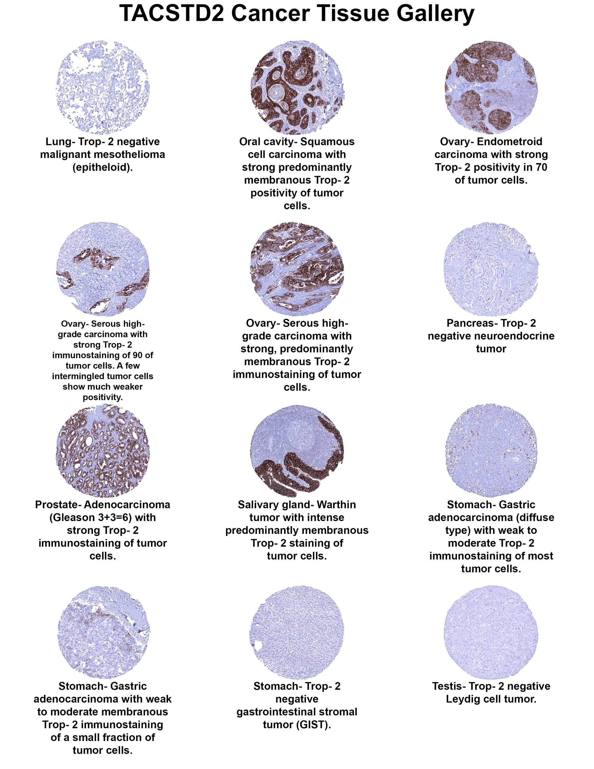TROP-2 Antibody (MSVA-733R) TROP-2 Antibody (MSVA-733R) TROP-2 Cancer Tissue Gallery