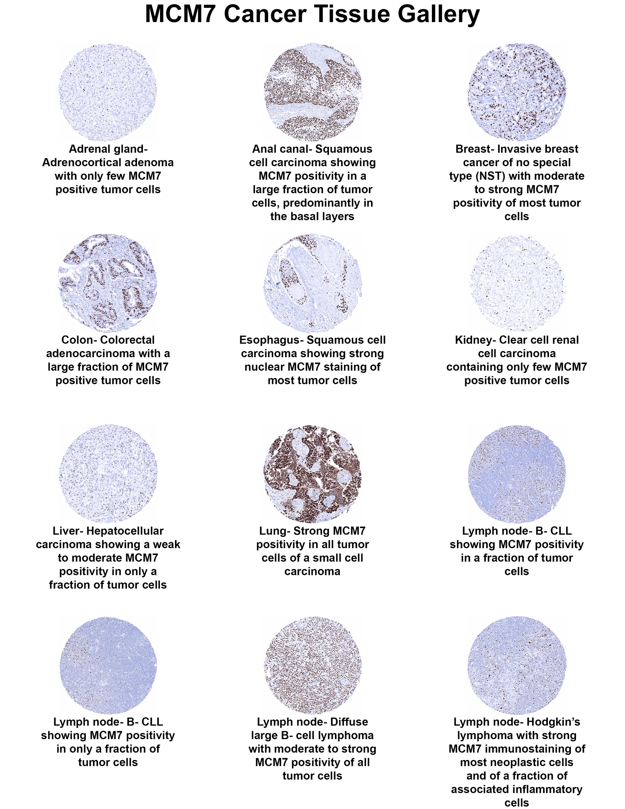 MCM7 Antibody (MSVA-507R) MCM7 Antibody (MSVA-507R) MCM7 Cancer Tissue Gallery