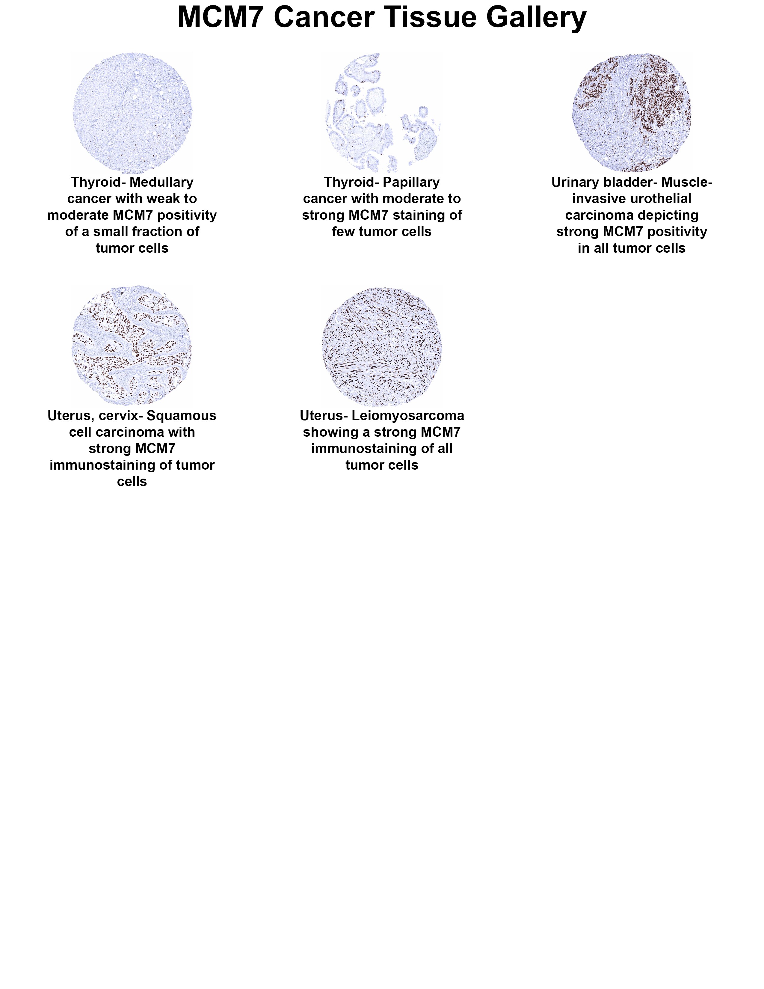 MCM7 Antibody (MSVA-507R) MCM7 Antibody (MSVA-507R) MCM7 Cancer Tissue Gallery