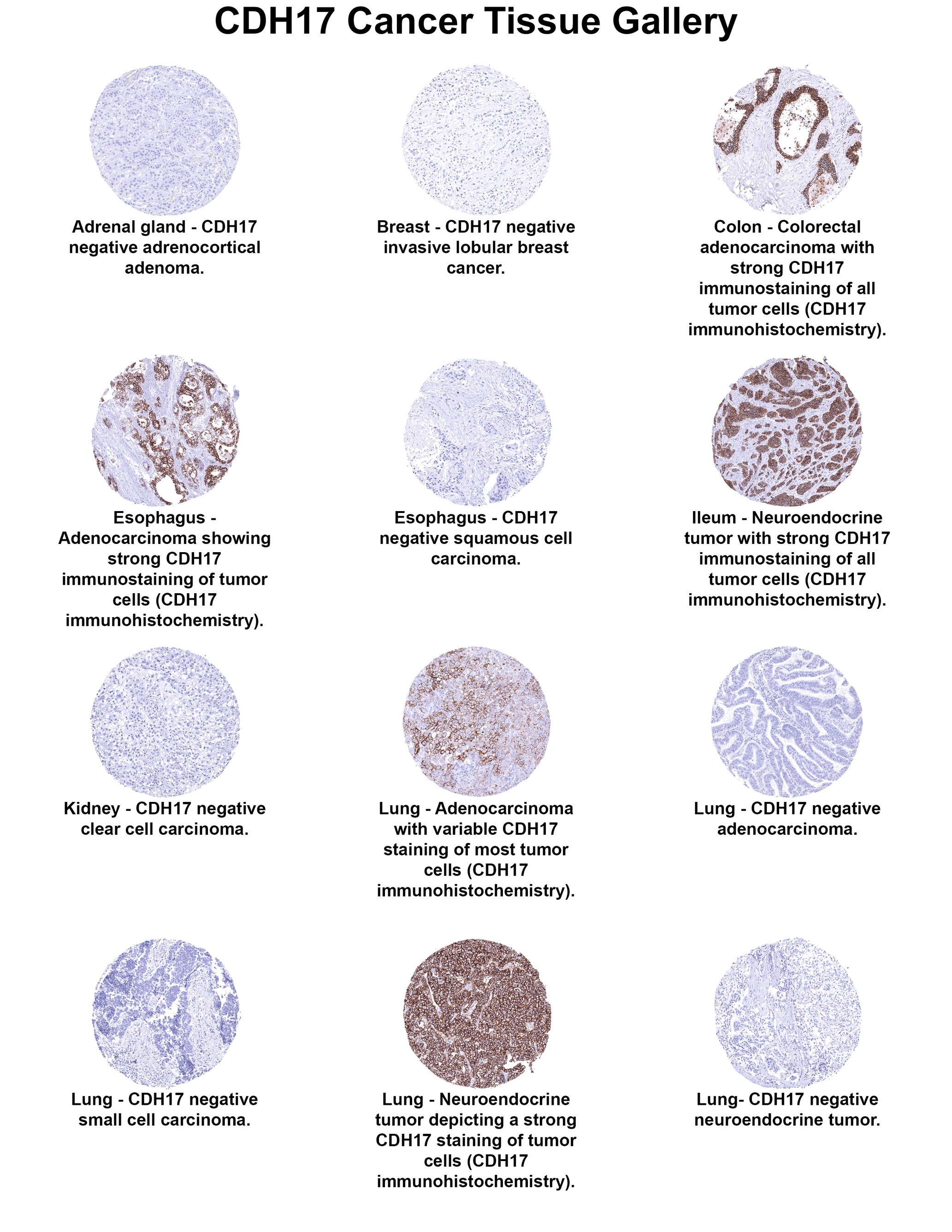 Cadherin-17 Antibody (MSVA-517M) Cadherin-17 Antibody (MSVA-517M) Cadherin-17 Cancer Tissue Gallery