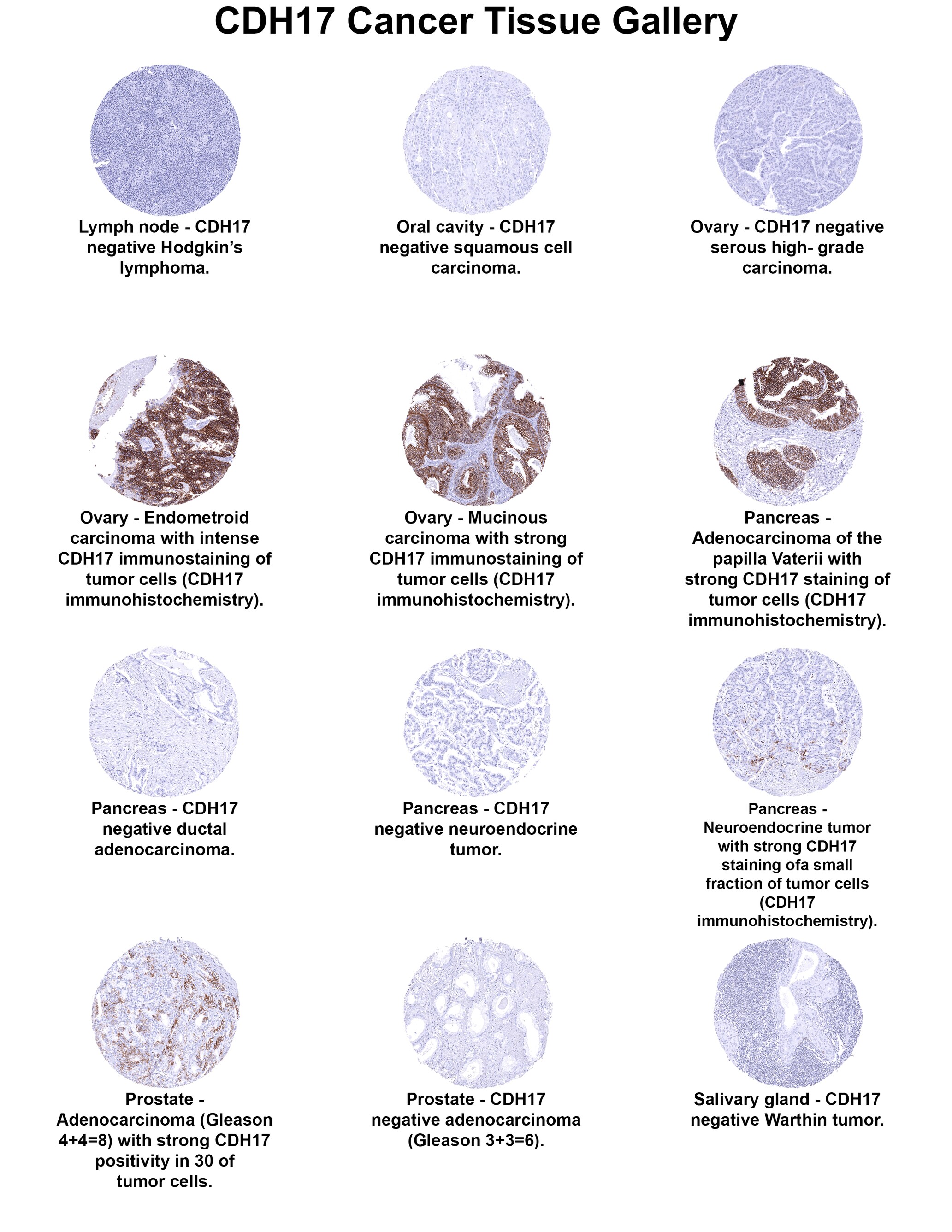 Cadherin-17 Antibody (MSVA-517M) Cadherin-17 Antibody (MSVA-517M) Cadherin-17 Cancer Tissue Gallery