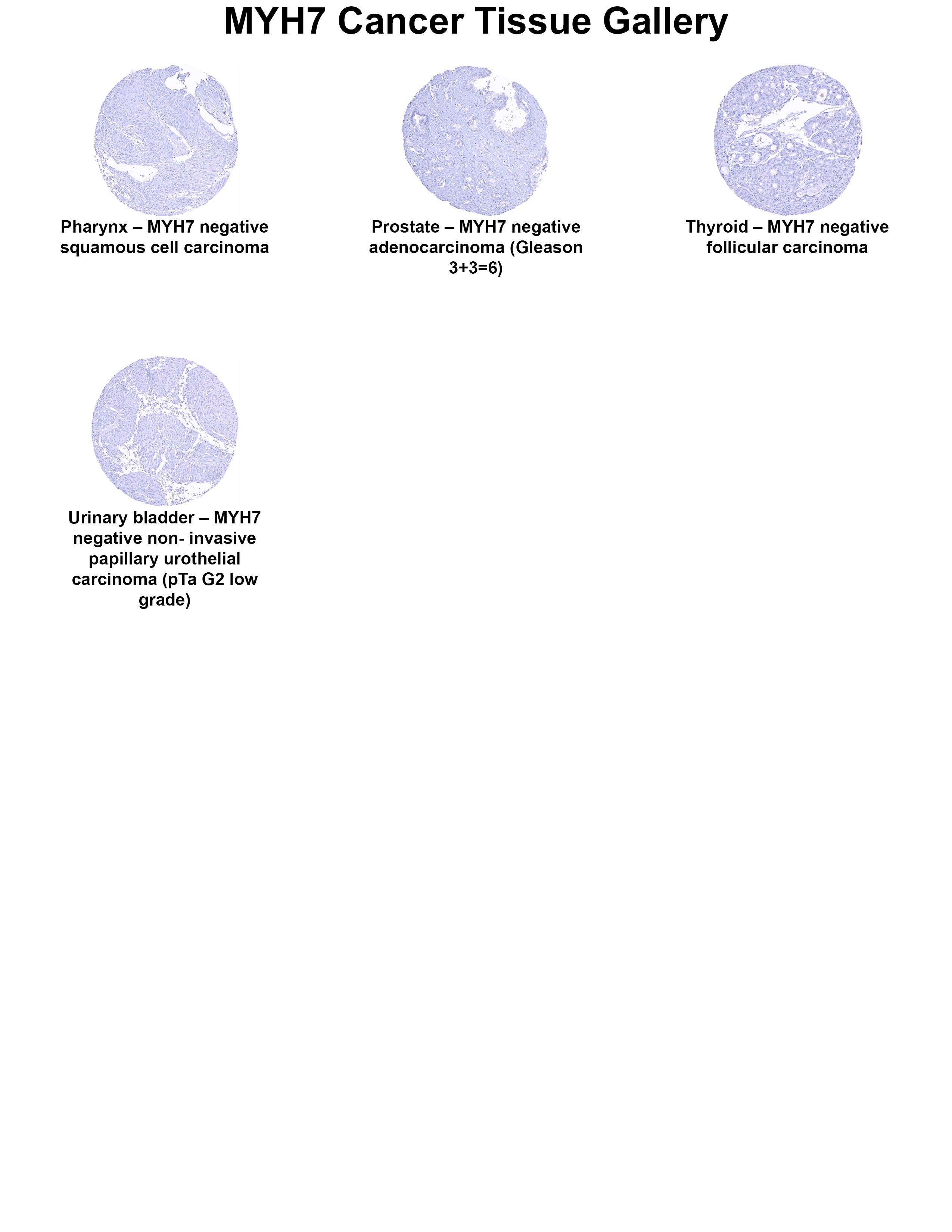 MYH7 Antibody (MSVA-464M) MYH7 Antibody (MSVA-464M) MYH7 Cancer Tissue Gallery