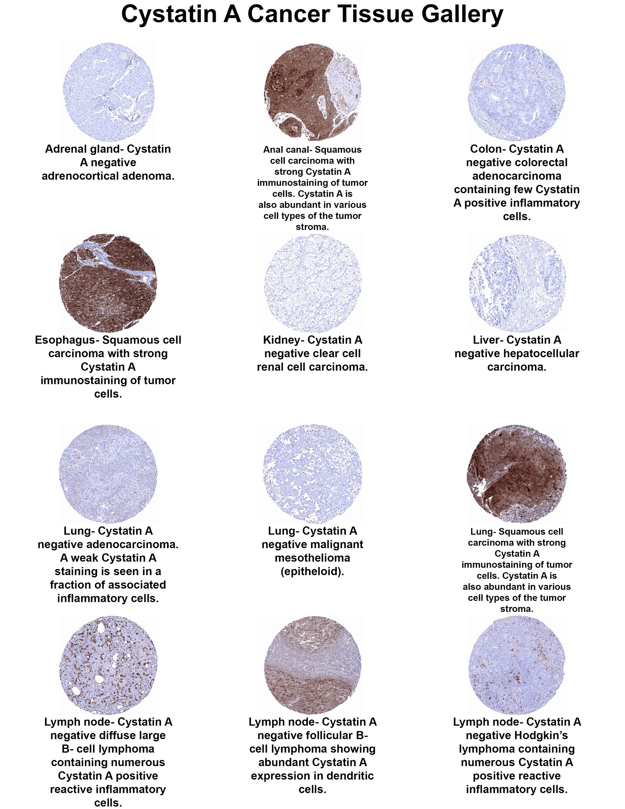 Cystatin A Antibody (MSVA-461M) Cystatin A Antibody (MSVA-461M) Cystatin A Cancer Tissue Gallery