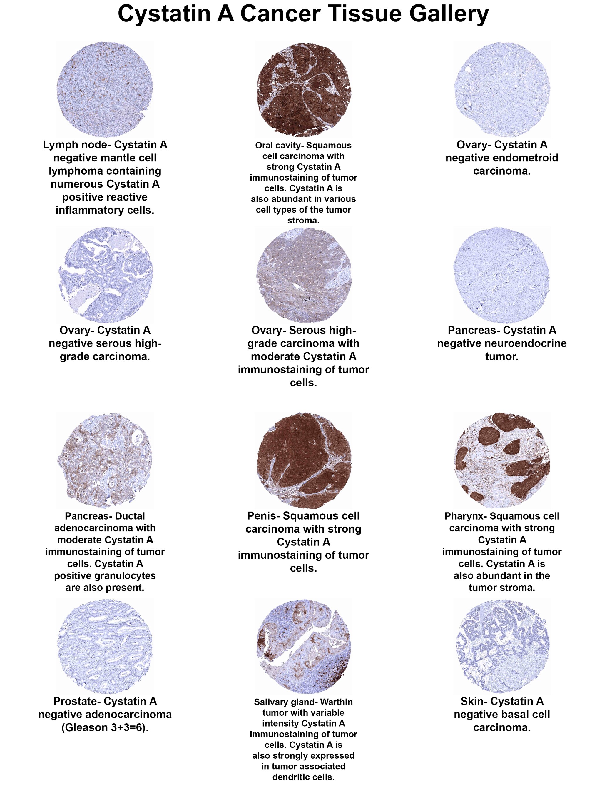Cystatin A Antibody (MSVA-461M) Cystatin A Antibody (MSVA-461M) Cystatin A Cancer Tissue Gallery