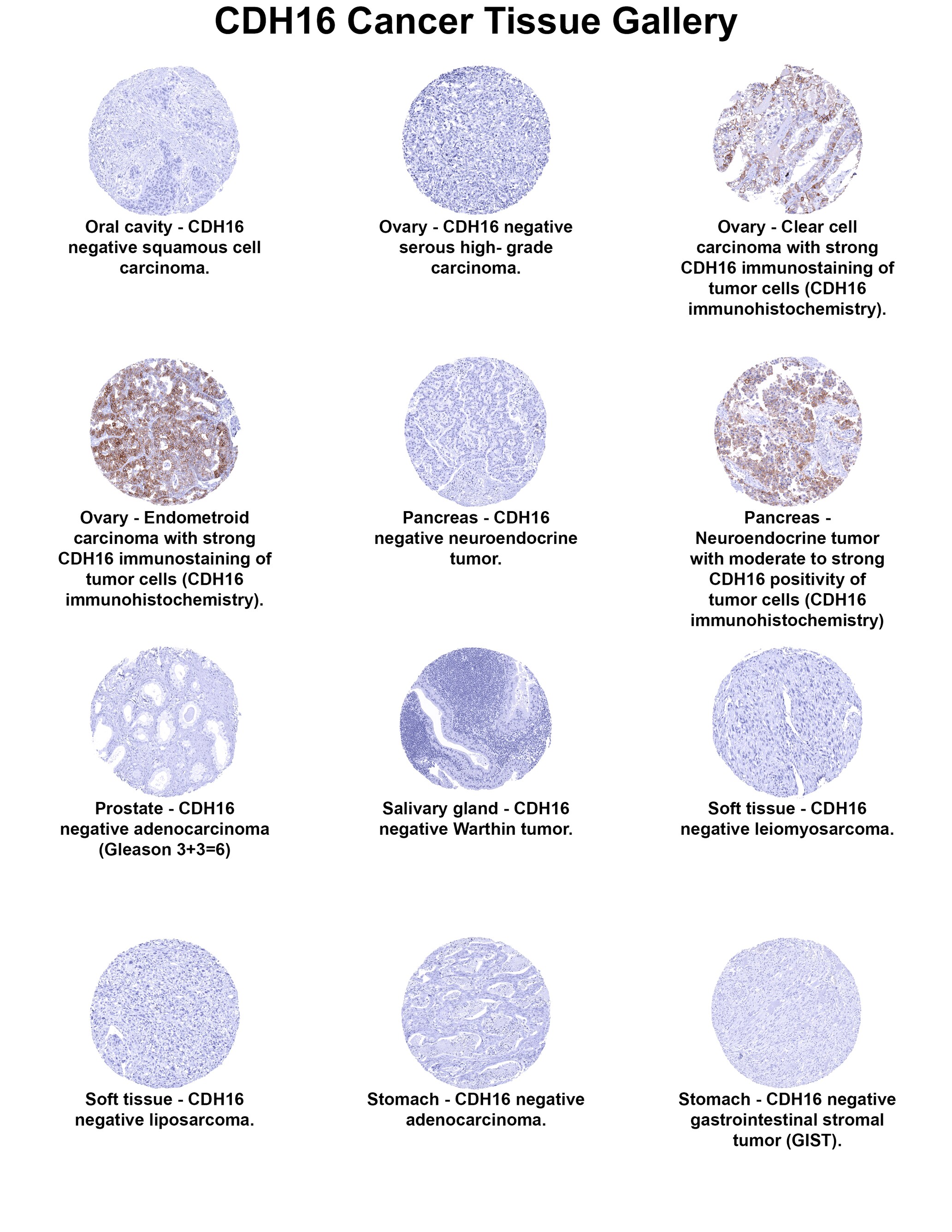 Cadherin-16 Antibody (MSVA-516R) Cadherin-16 Antibody (MSVA-516R) Cadherin-16 Cancer Tissue Gallery