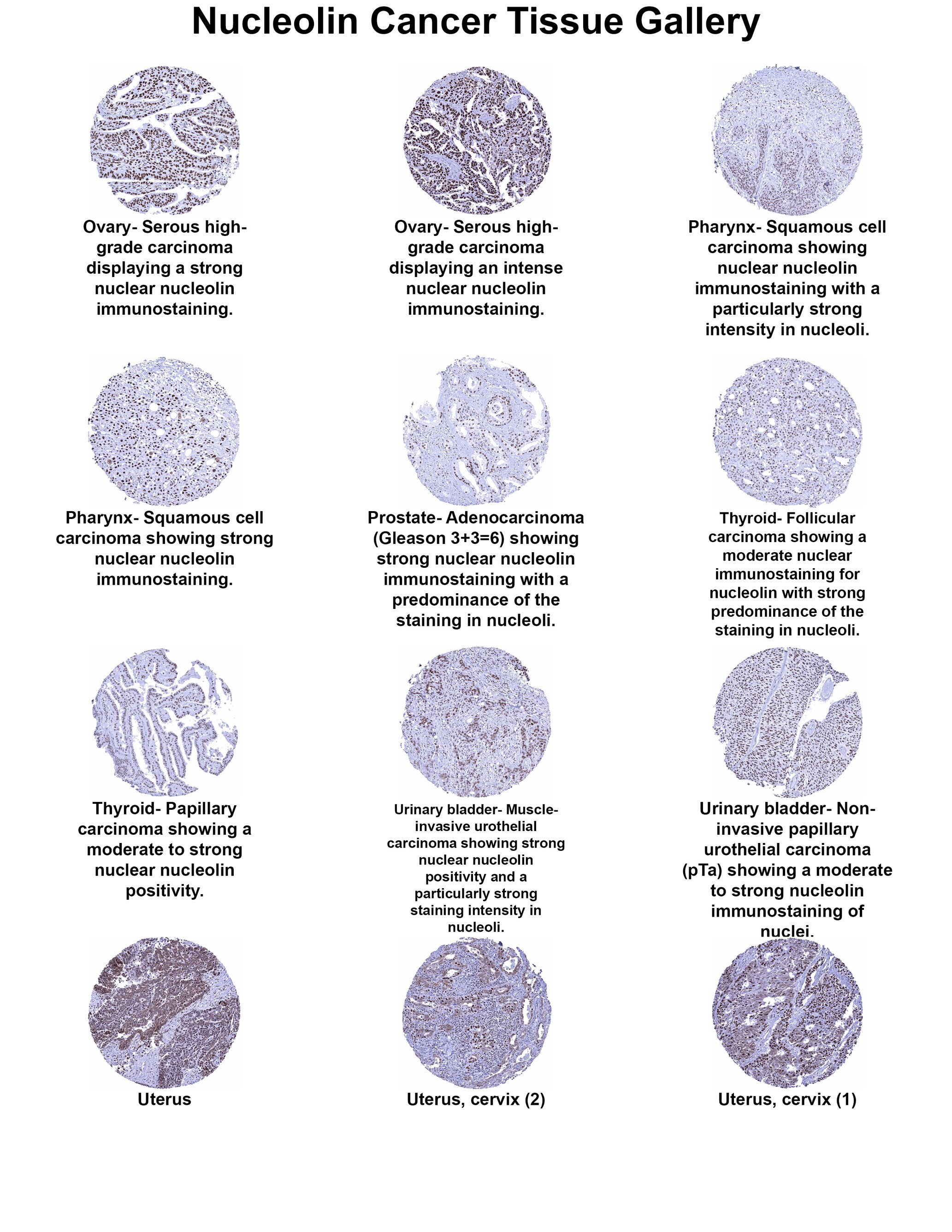 Nucleolin Antibody (MSVA-623R) Nucleolin Antibody (MSVA-623R) Nucleolin Cancer Tissue Gallery