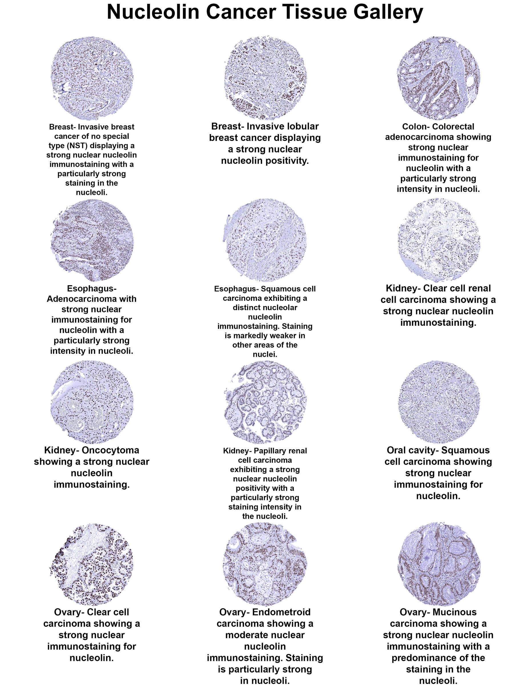 Nucleolin Antibody (MSVA-623R) Nucleolin Antibody (MSVA-623R) Nucleolin Cancer Tissue Gallery