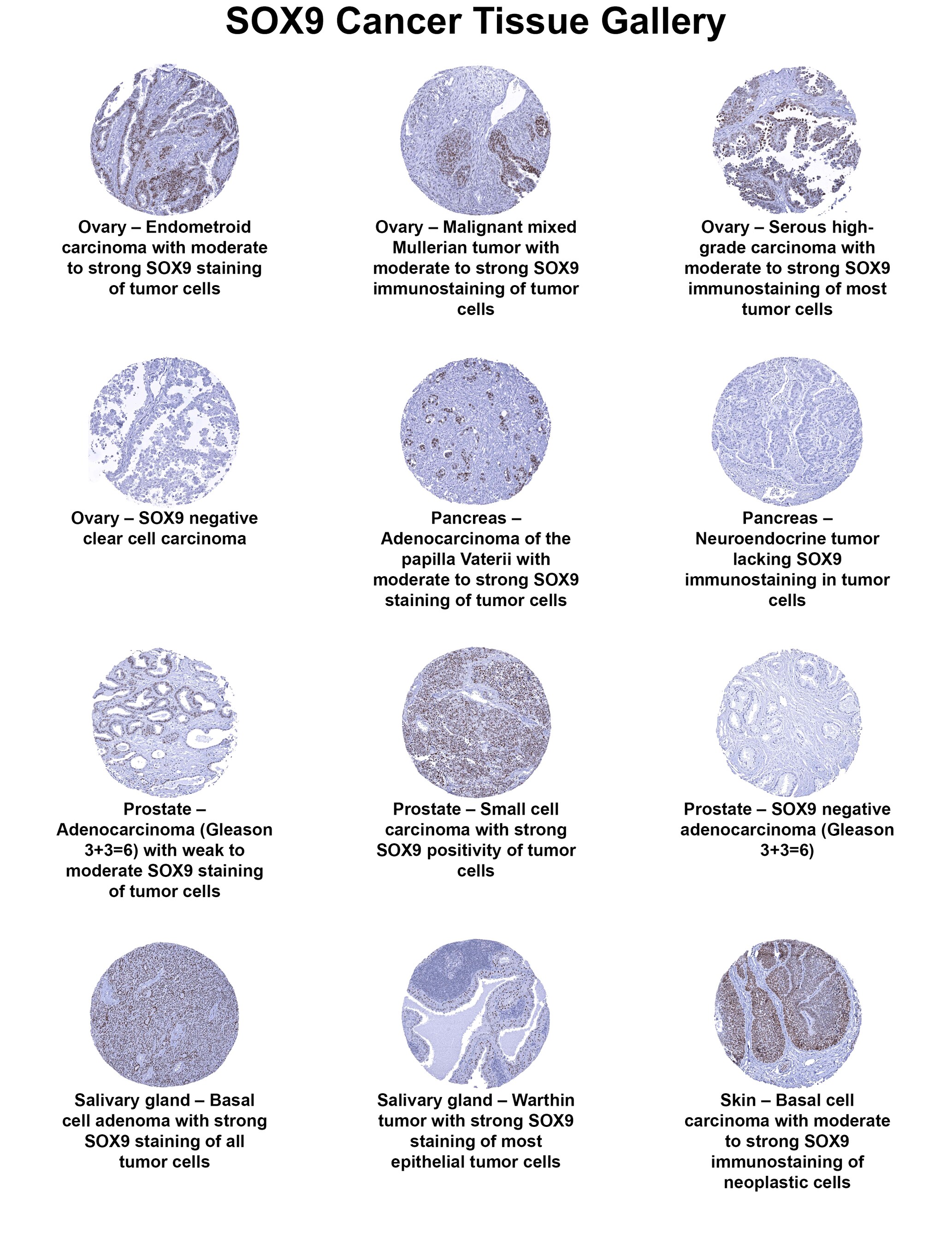 SOX9 Antibody (MSVA-709R) SOX9 Antibody (MSVA-709R) SOX9 Cancer Tissue Gallery