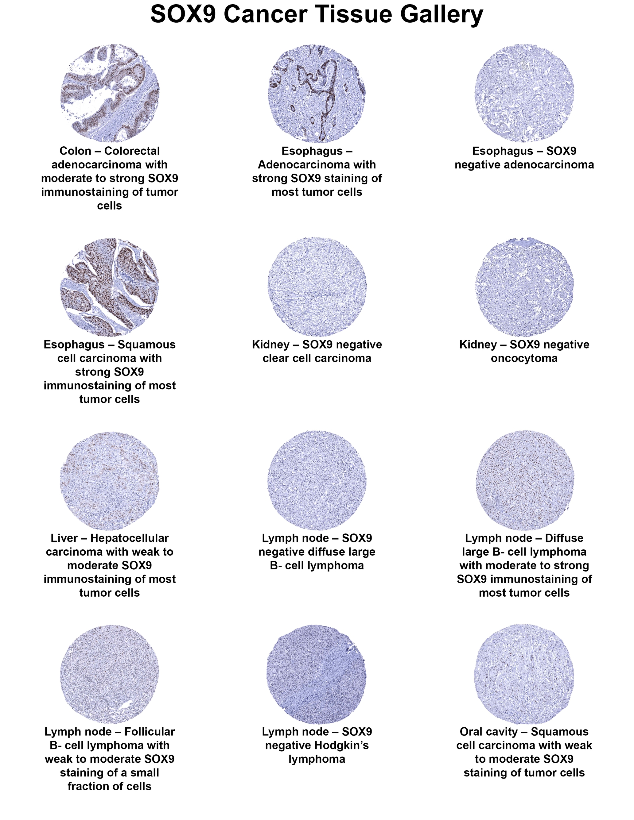 SOX9 Antibody (MSVA-709R) SOX9 Antibody (MSVA-709R) SOX9 Cancer Tissue Gallery
