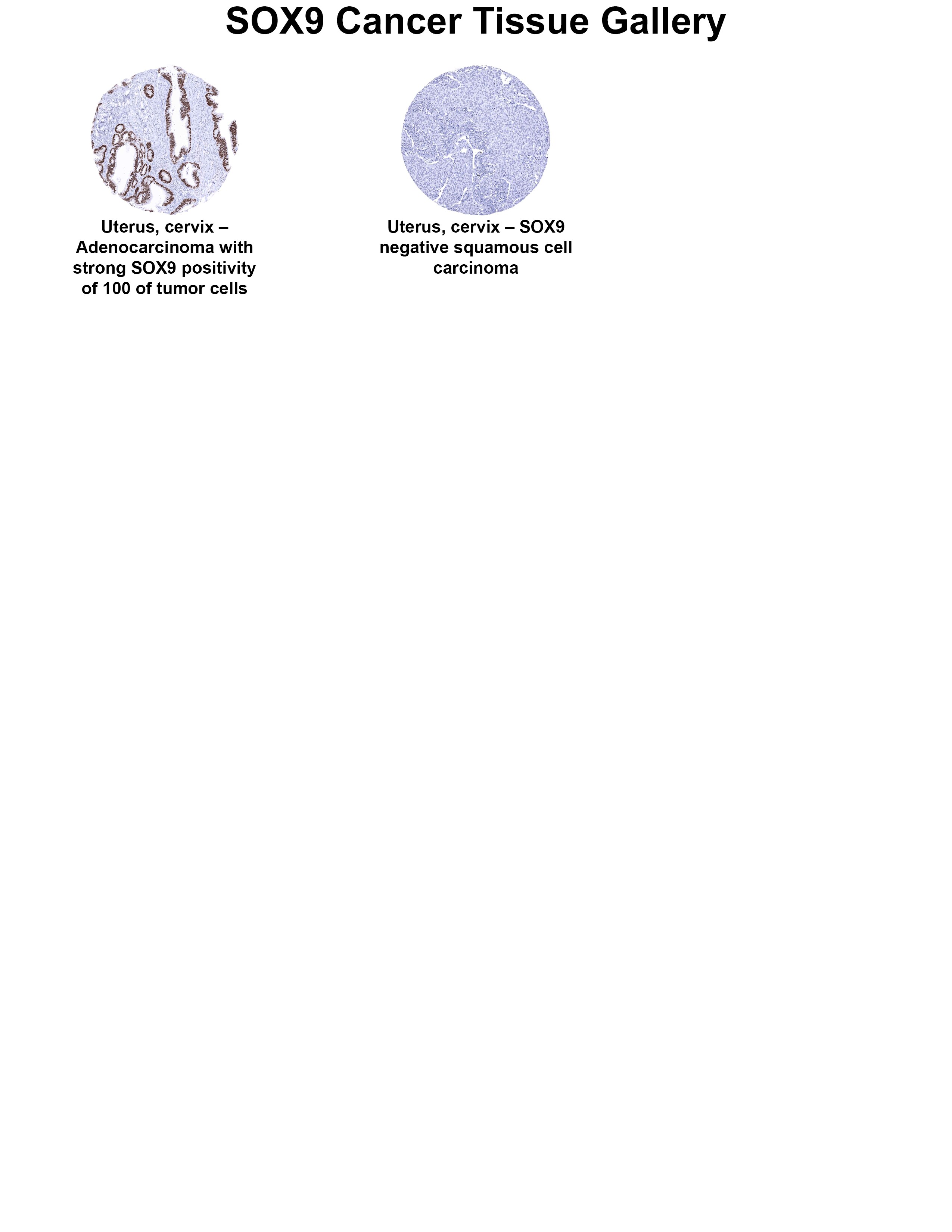 SOX9 Antibody (MSVA-709R) SOX9 Antibody (MSVA-709R) SOX9 Cancer Tissue Gallery