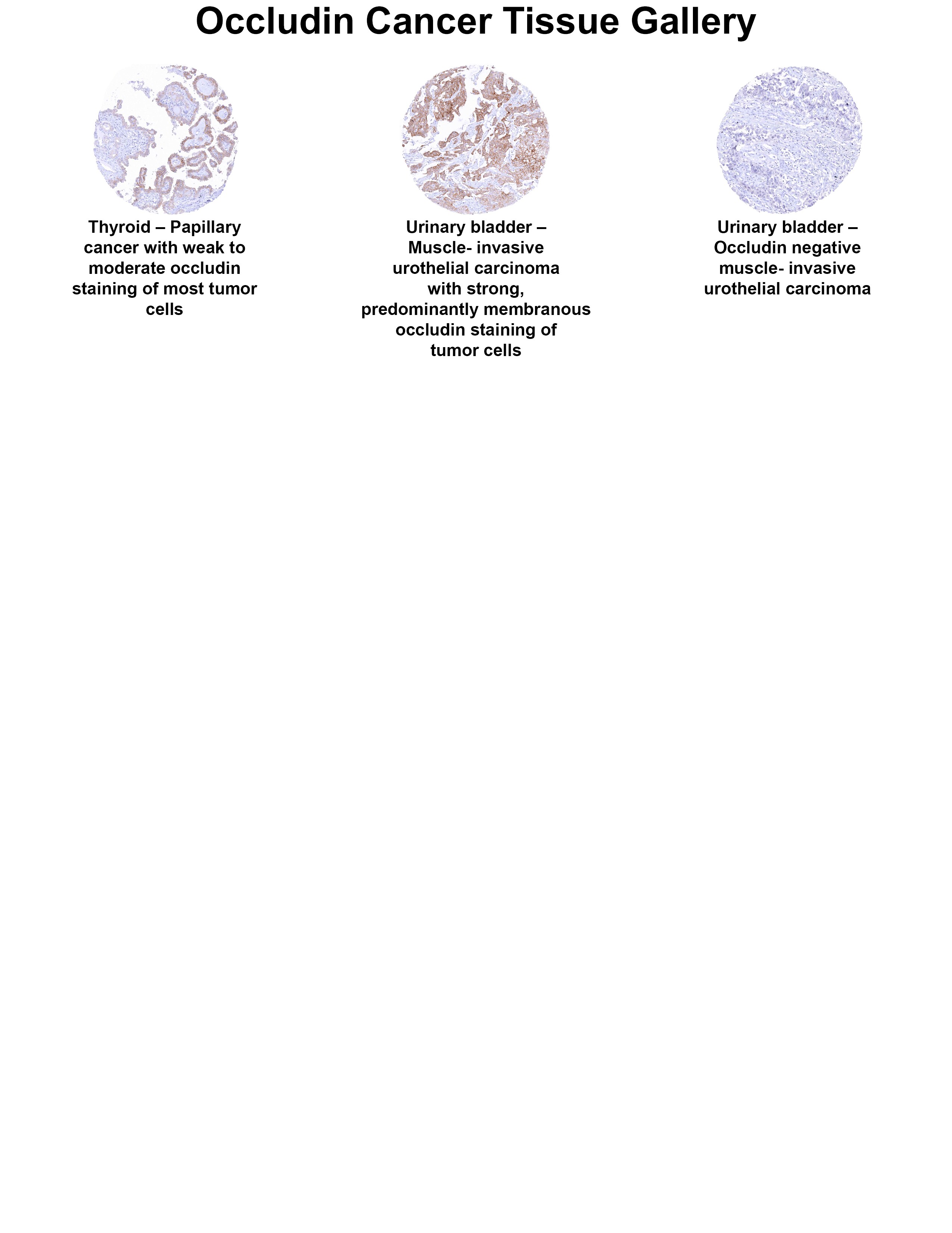 Occludin Antibody (MSVA-415M) Occludin Antibody (MSVA-415M) Occludin Cancer Tissue Gallery