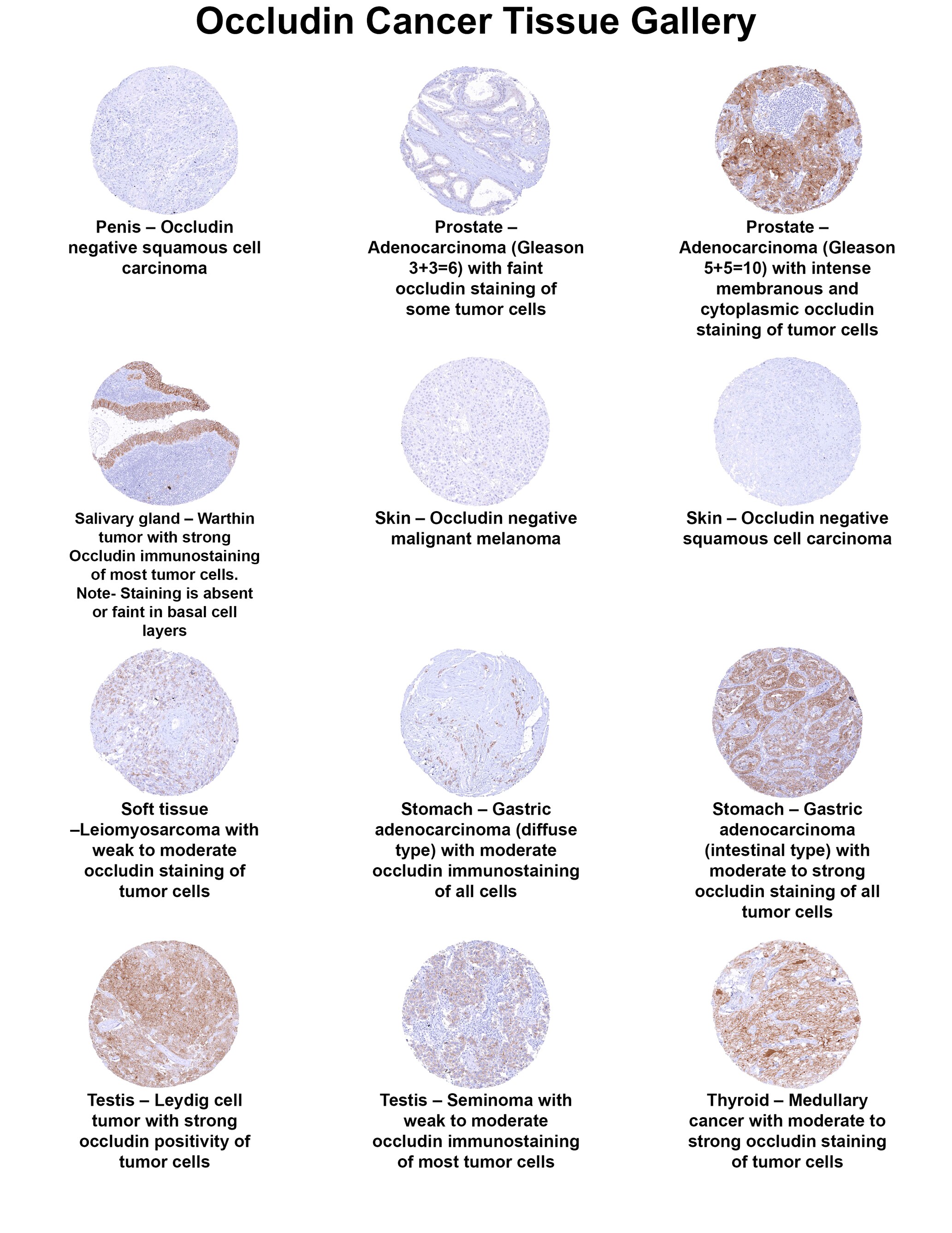 Occludin Antibody (MSVA-415M) Occludin Antibody (MSVA-415M) Occludin Cancer Tissue Gallery
