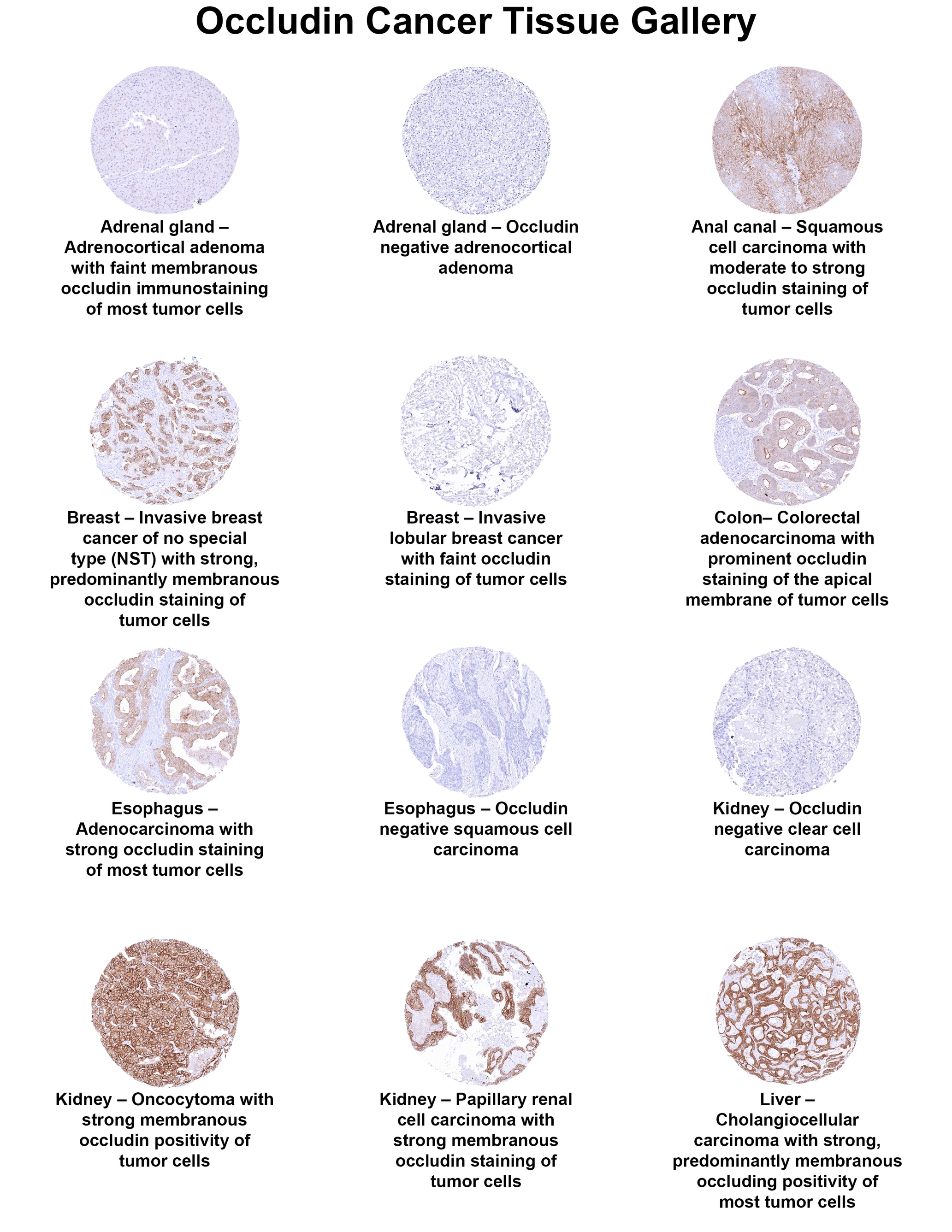 Occludin Antibody (MSVA-415M) Occludin Antibody (MSVA-415M) Occludin Cancer Tissue Gallery