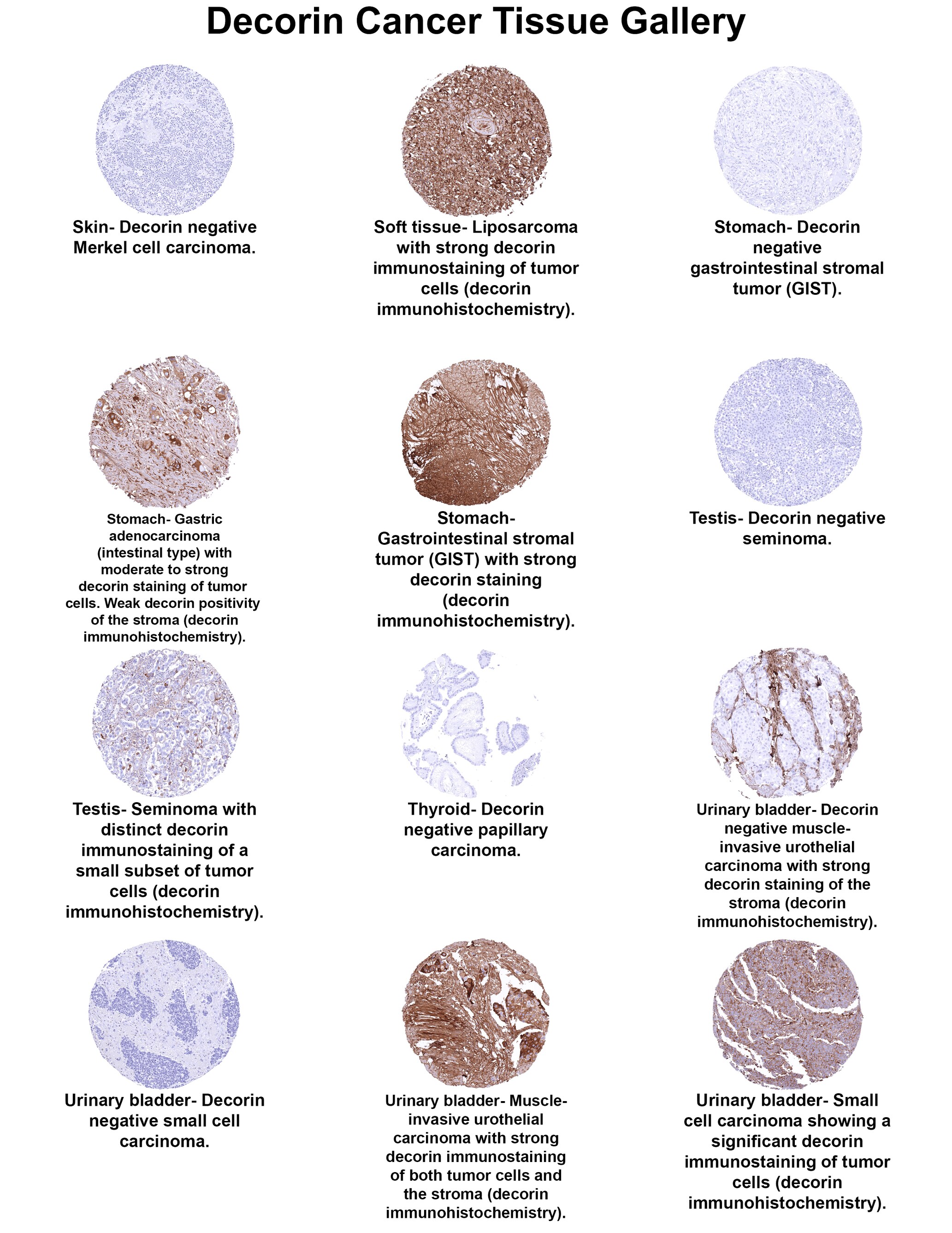 Decorin Antibody (MSVA-537R) Decorin Antibody (MSVA-537R) Decorin Cancer Tissue Gallery