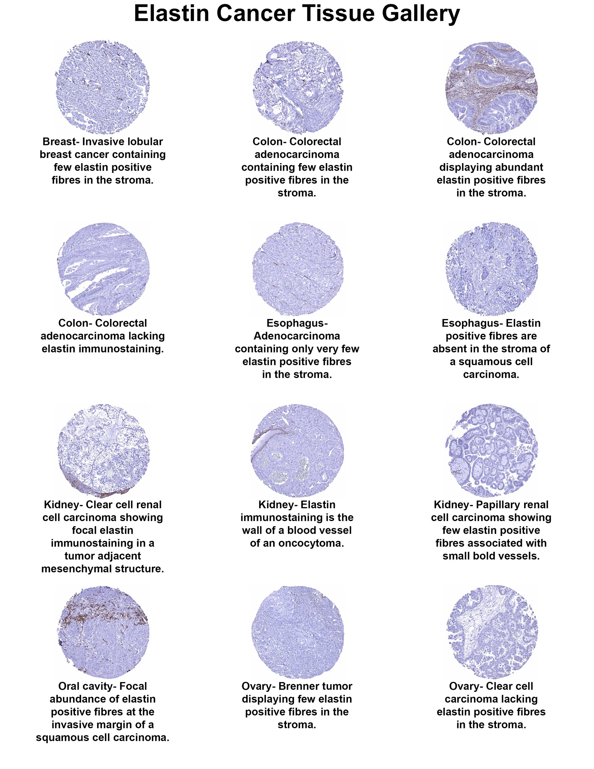 Elastin Antibody (MSVA-648R) Elastin Antibody (MSVA-648R) Elastin Cancer Tissue Gallery