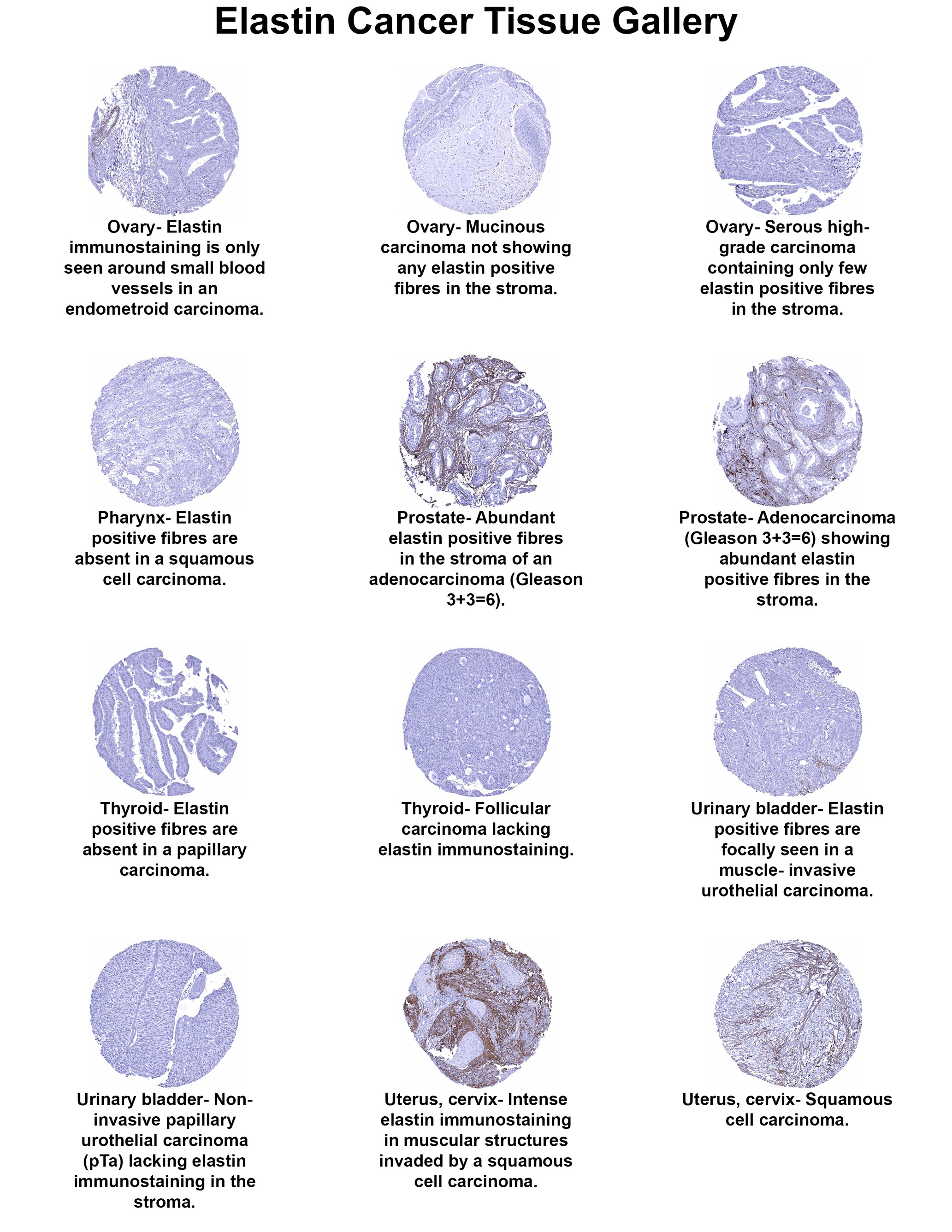 Elastin Antibody (MSVA-648R) Elastin Antibody (MSVA-648R) Elastin Cancer Tissue Gallery
