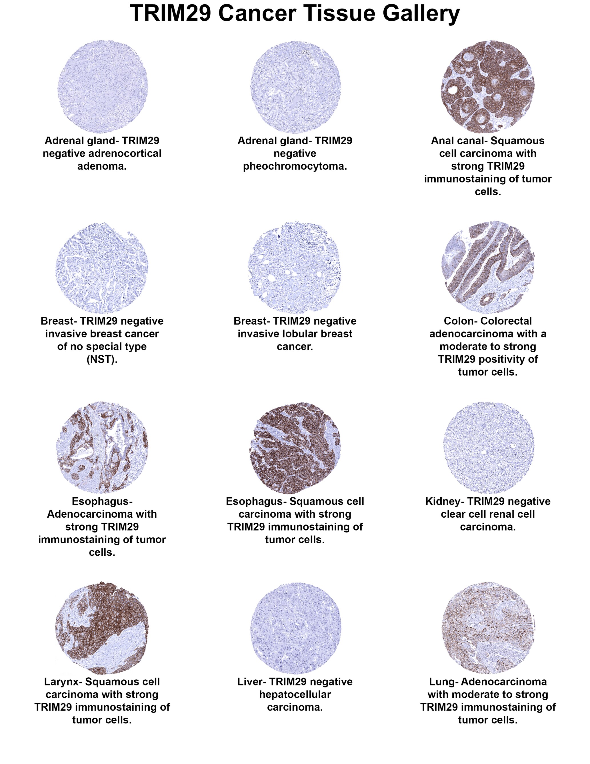 TRIM29 Antibody (MSVA-629M) TRIM29 Antibody (MSVA-629M) TRIM29 Cancer Tissue Gallery