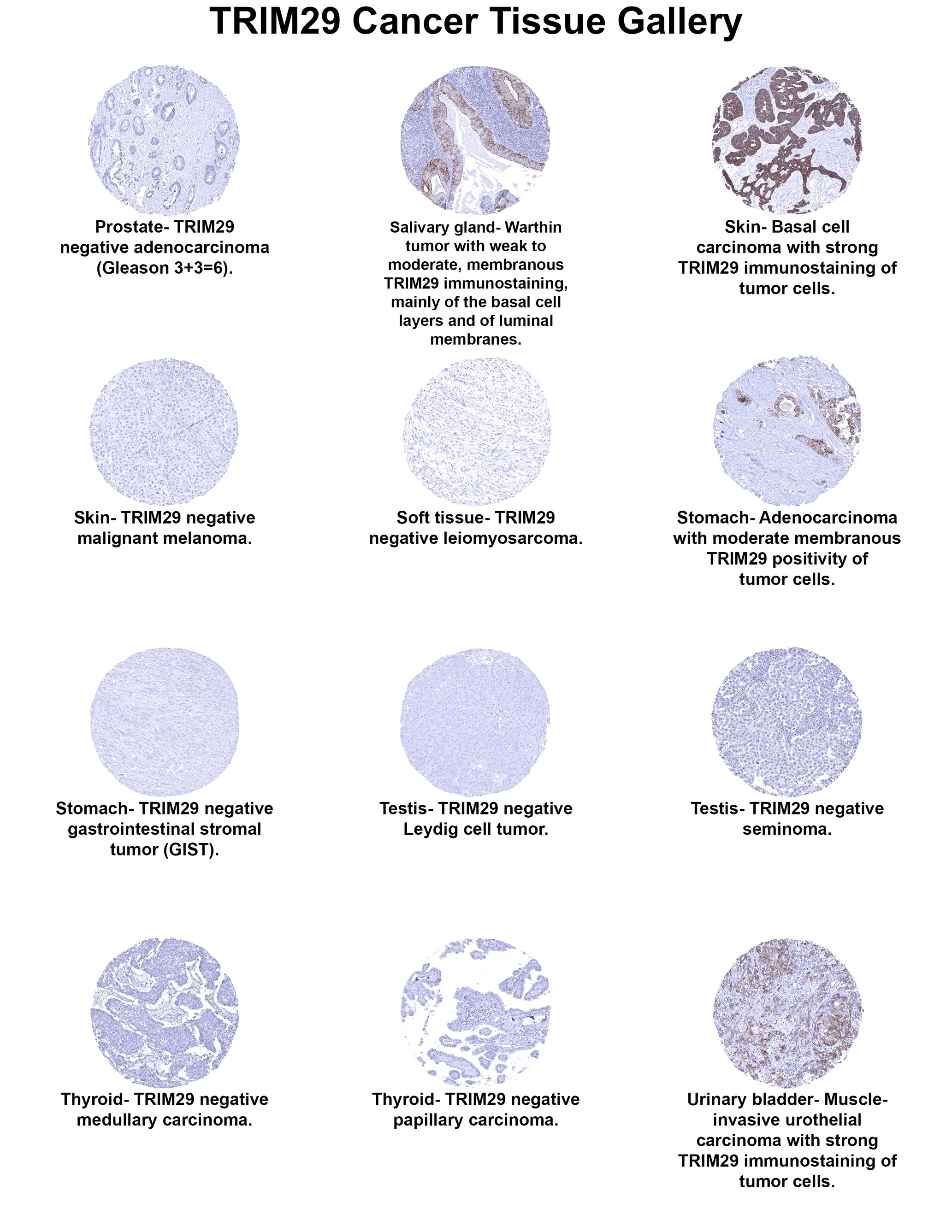 TRIM29 Antibody (MSVA-629M) TRIM29 Antibody (MSVA-629M) TRIM29 Cancer Tissue Gallery