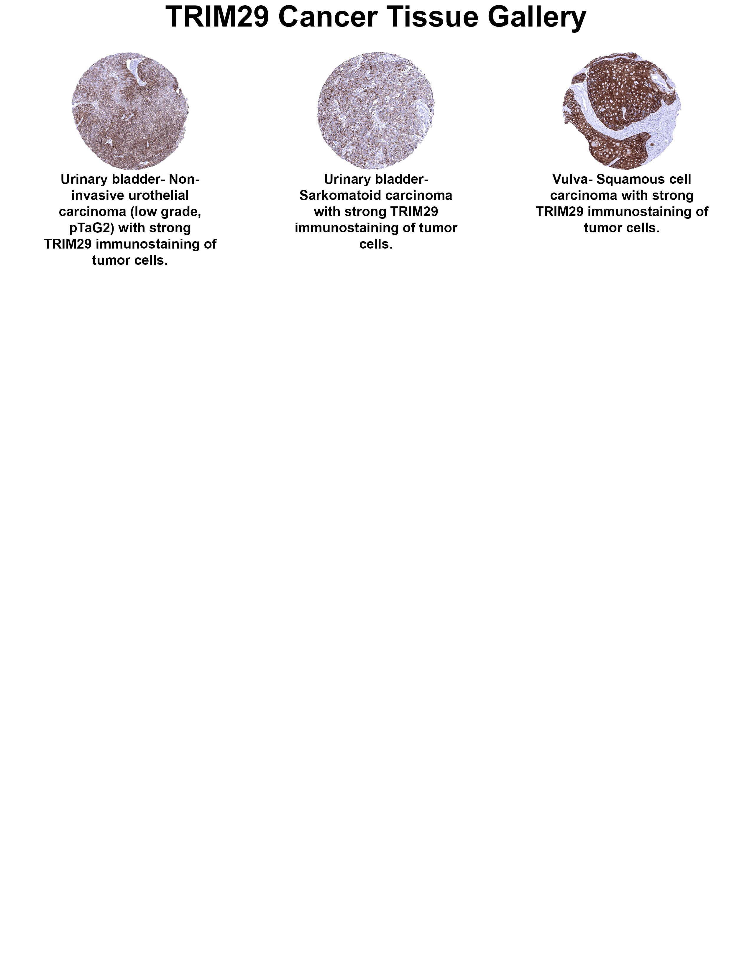 TRIM29 Antibody (MSVA-629M) TRIM29 Antibody (MSVA-629M) TRIM29 Cancer Tissue Gallery