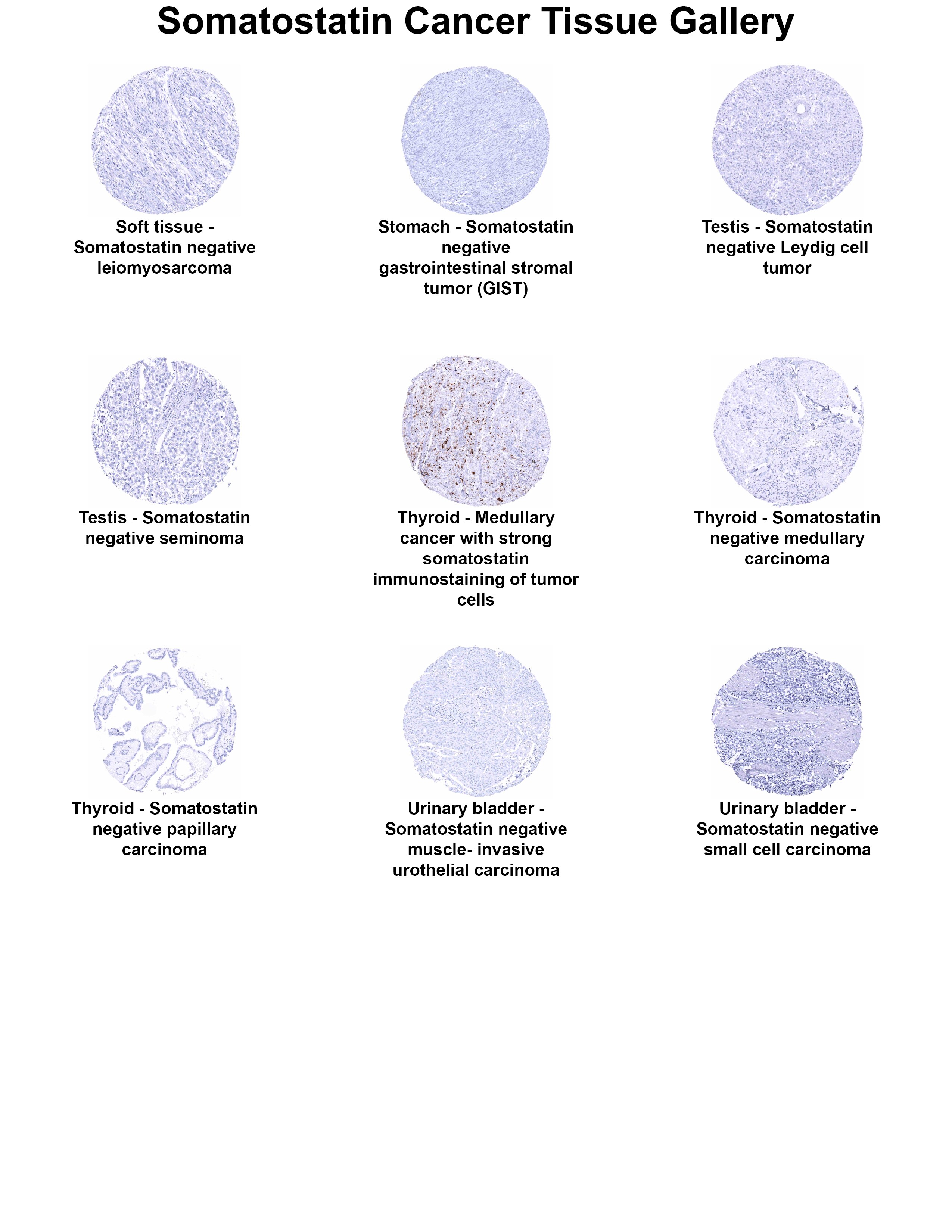 Somatostatin Antibody (MSVA-638R) Somatostatin Antibody (MSVA-638R) Somatostatin Cancer Tissue Gallery