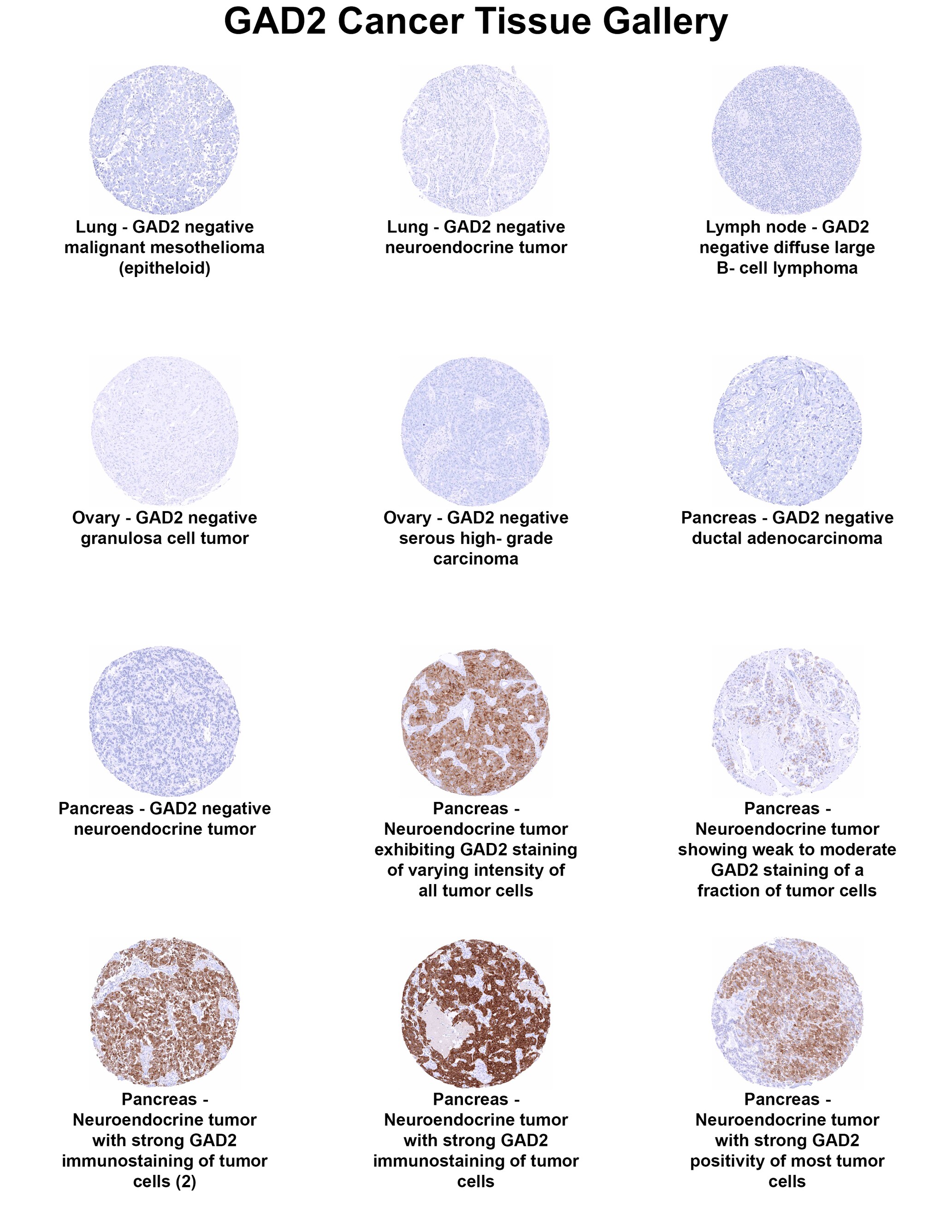 GAD2/GAD65 Antibody (MSVA-602M) GAD2/GAD65 Antibody (MSVA-602M) GAD2/GAD65 Cancer Tissue Gallery